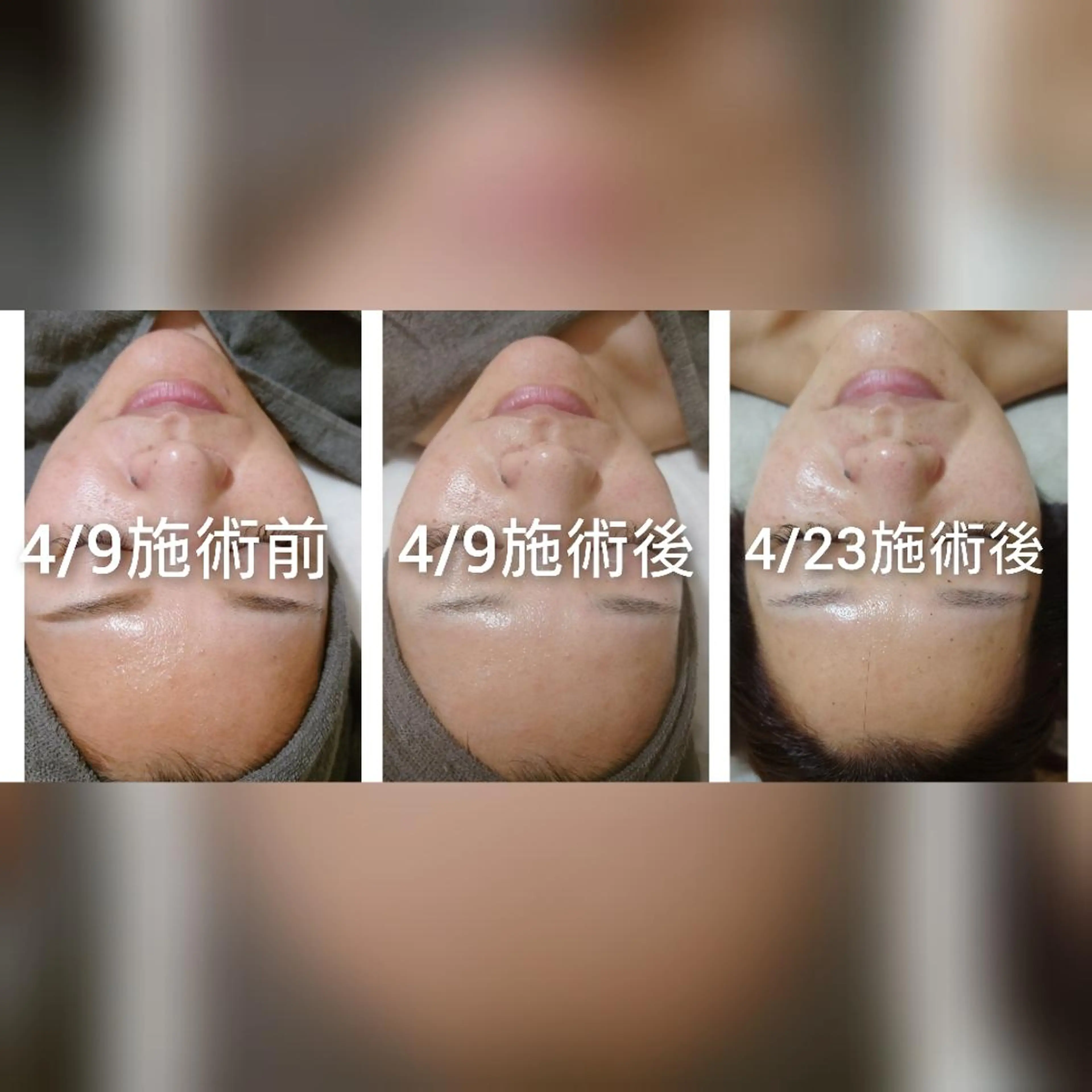 Luanaまつパ脱毛 ハーブピーリング眉毛のマツエク・マツパデザイン