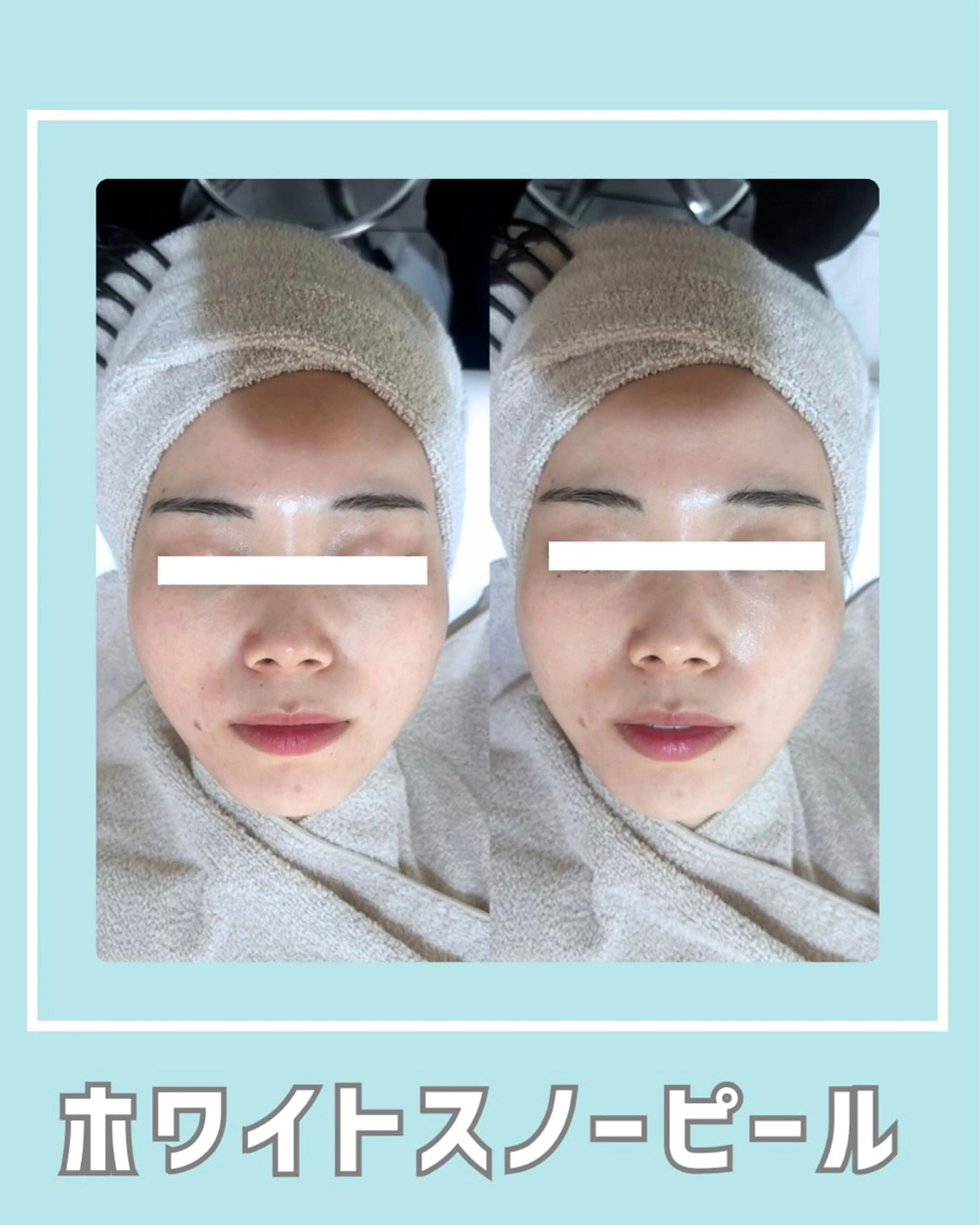 エステ |ピーリング・毛穴| soina神楽坂のエステ・リラクイメージ