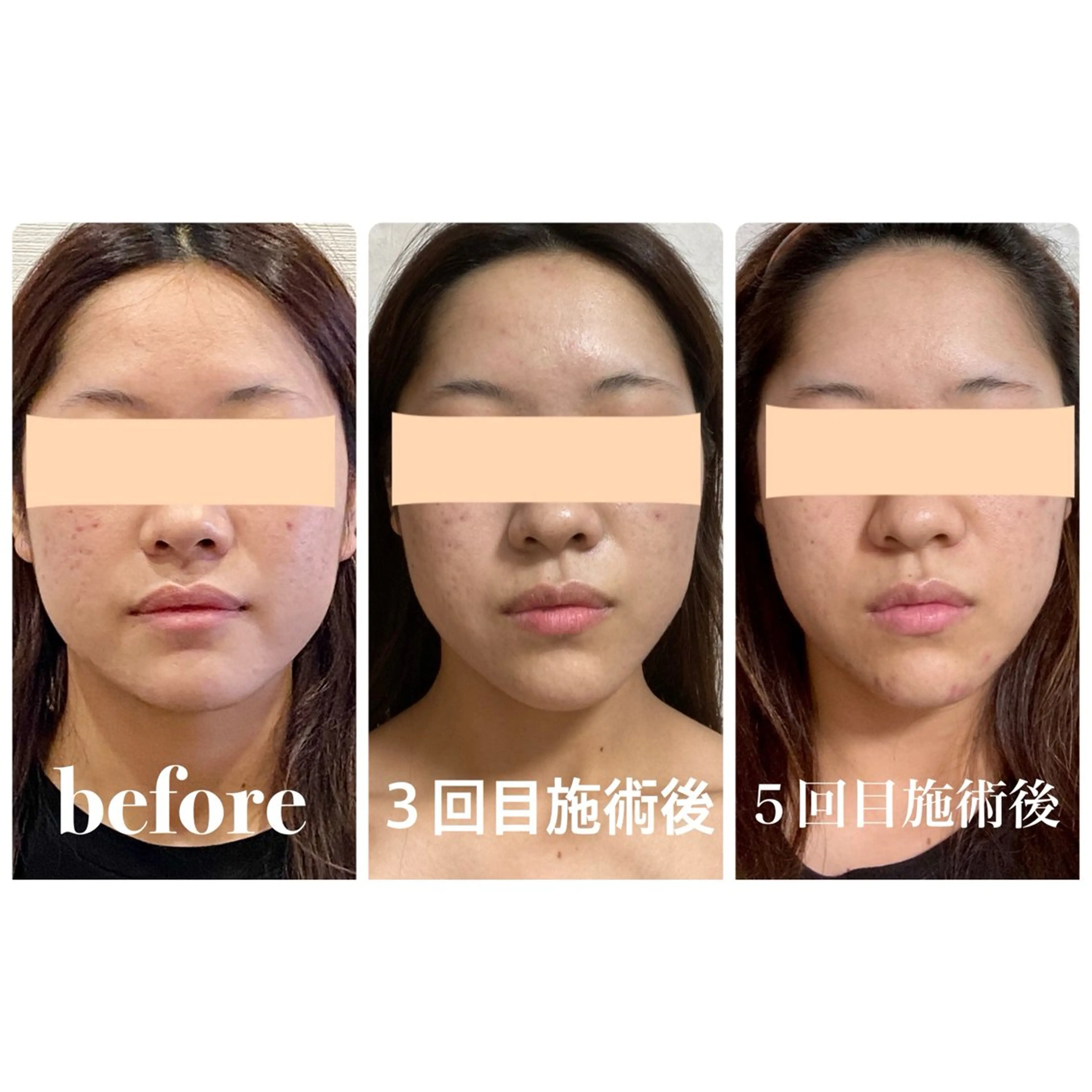 【口コミ投稿＆ビフォーアフター掲載許可でお得‼️】の写真