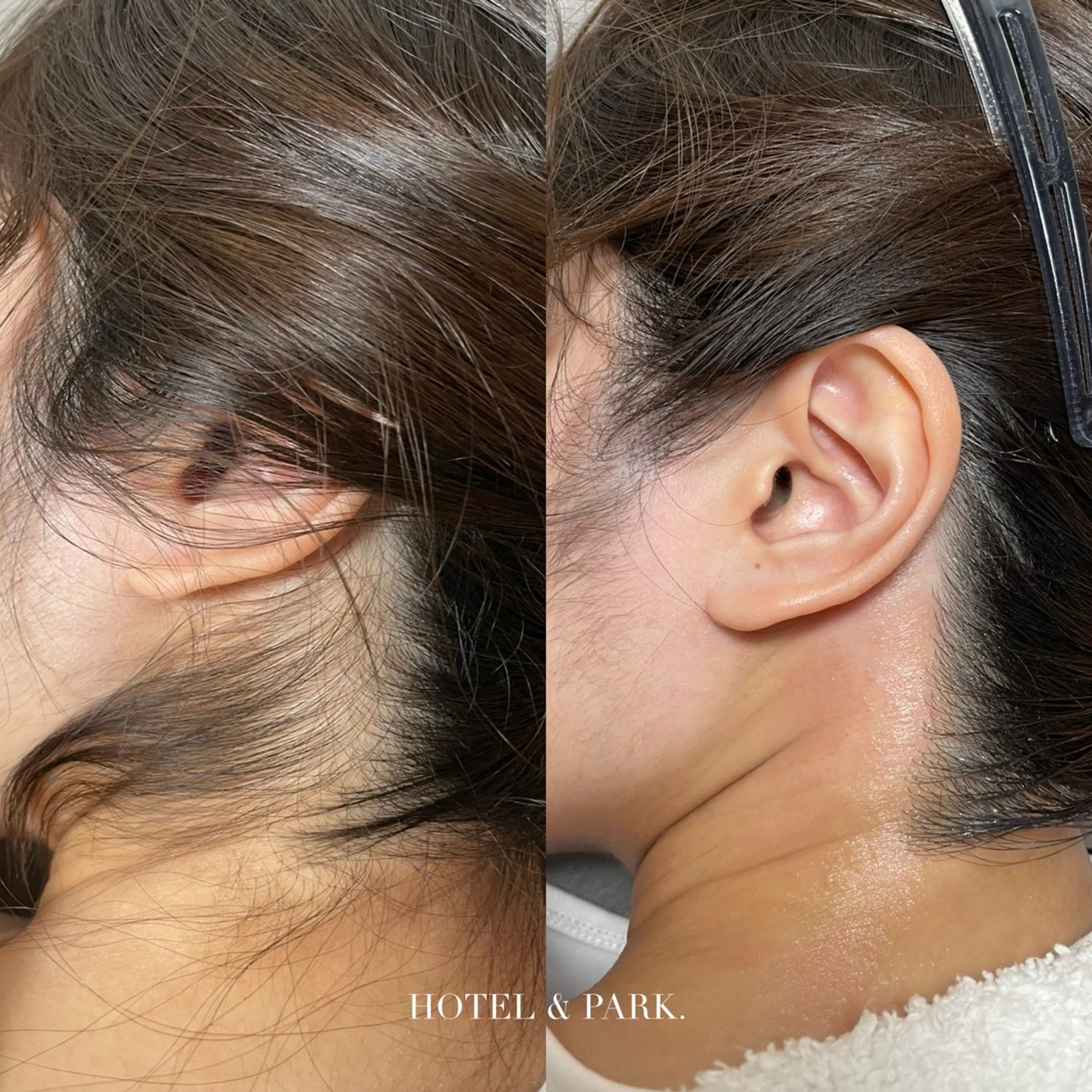 脱毛 HOTEL&PARK . ワックス脱毛のエステ・リラクイメージ