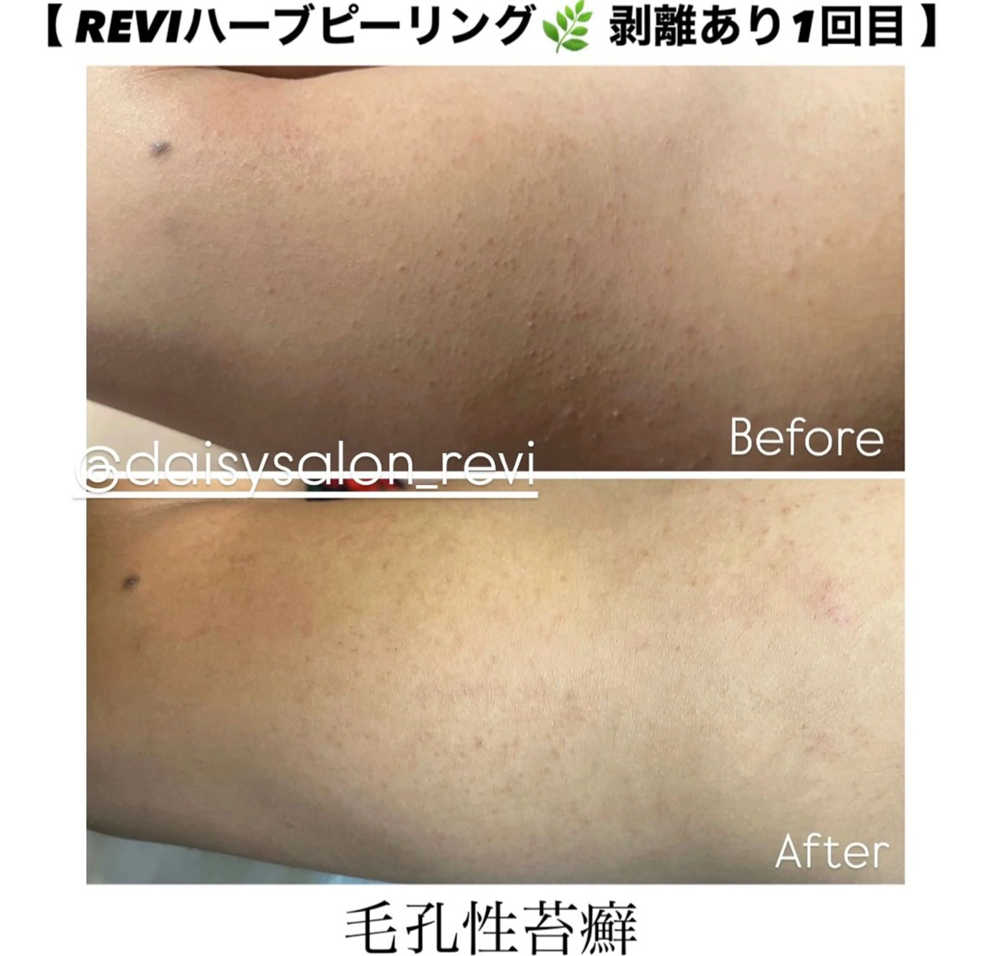 背中上・背中下・肘下・肘上・膝下・膝上・お尻・お腹・デコルテ・バスト 【 お好きな箇所 】REVIハーブピーリング🌿の写真