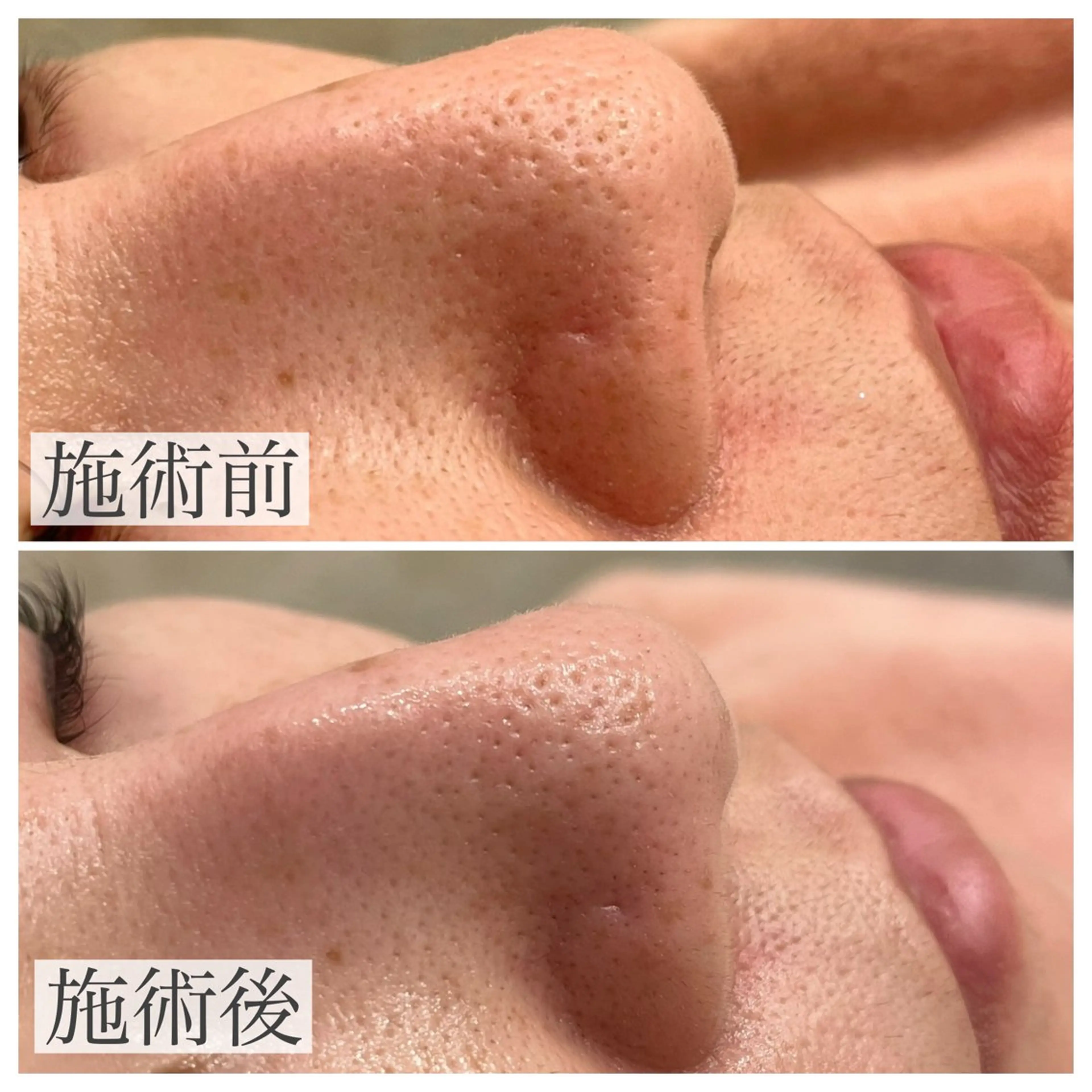 emiluca西目/ 毛穴洗浄/細胞美容のエステ・リラクイメージ