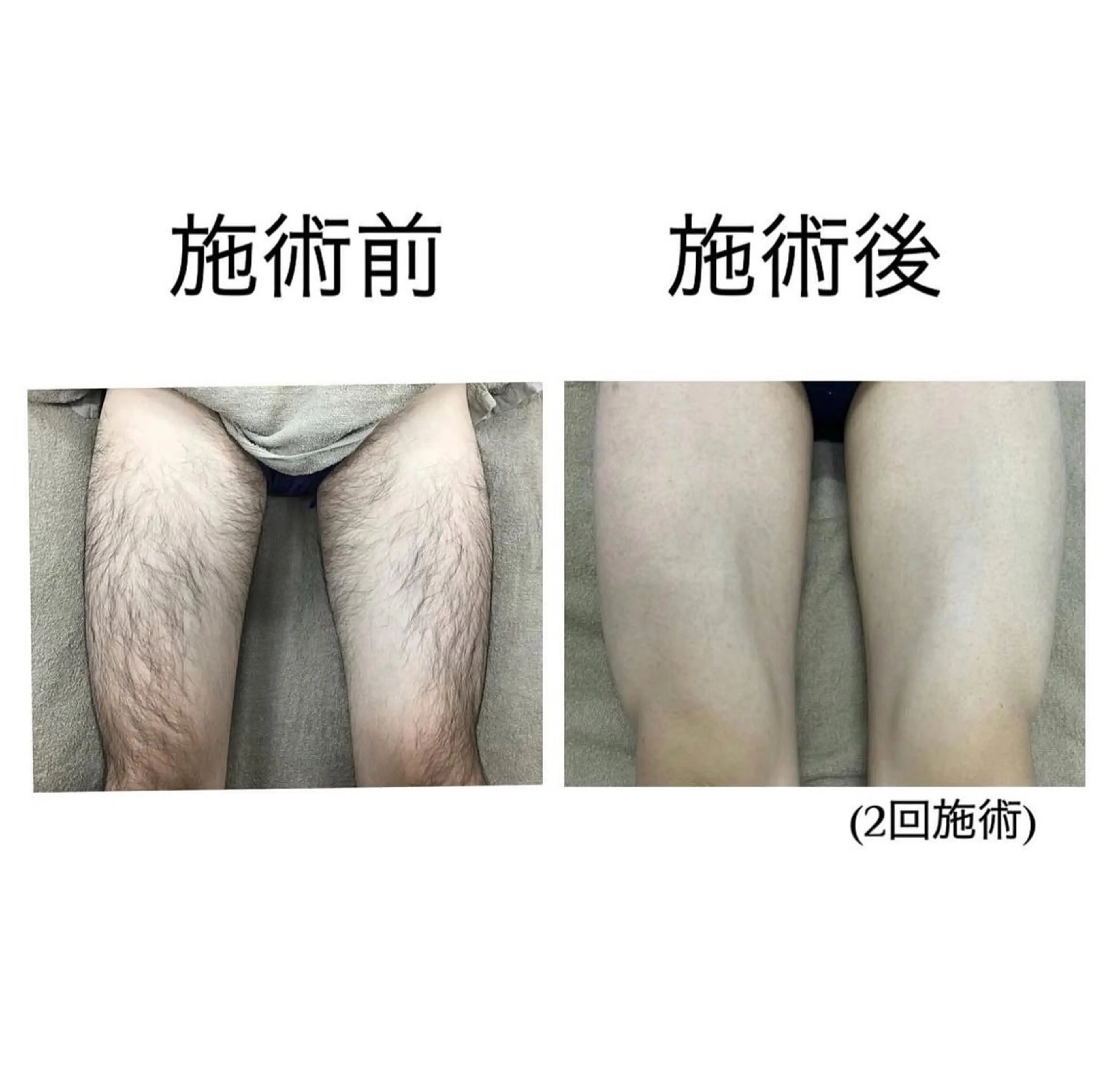 下半身脱毛の写真
