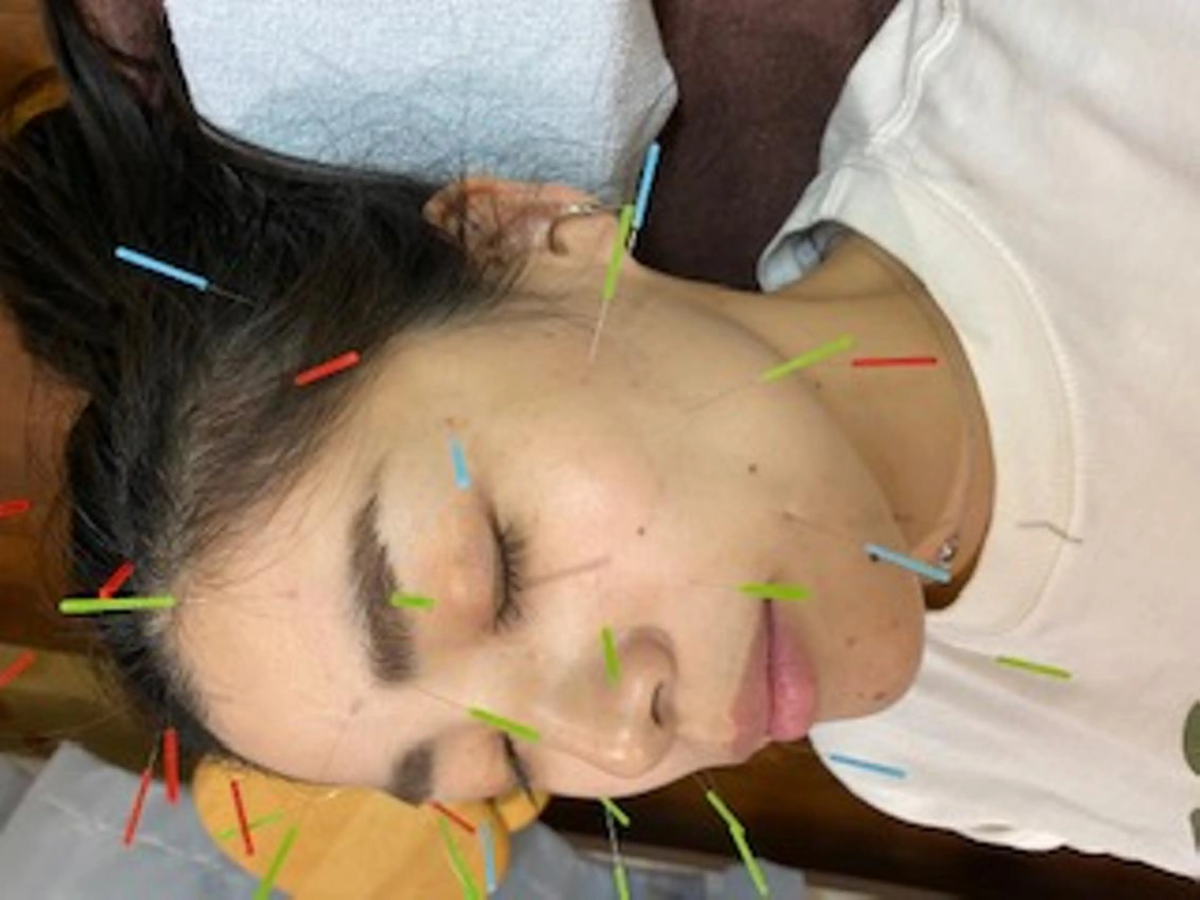 [初回限定]当院独自の整体BC-MT療法＋フェイシャル美容鍼　6000円→5500円の写真