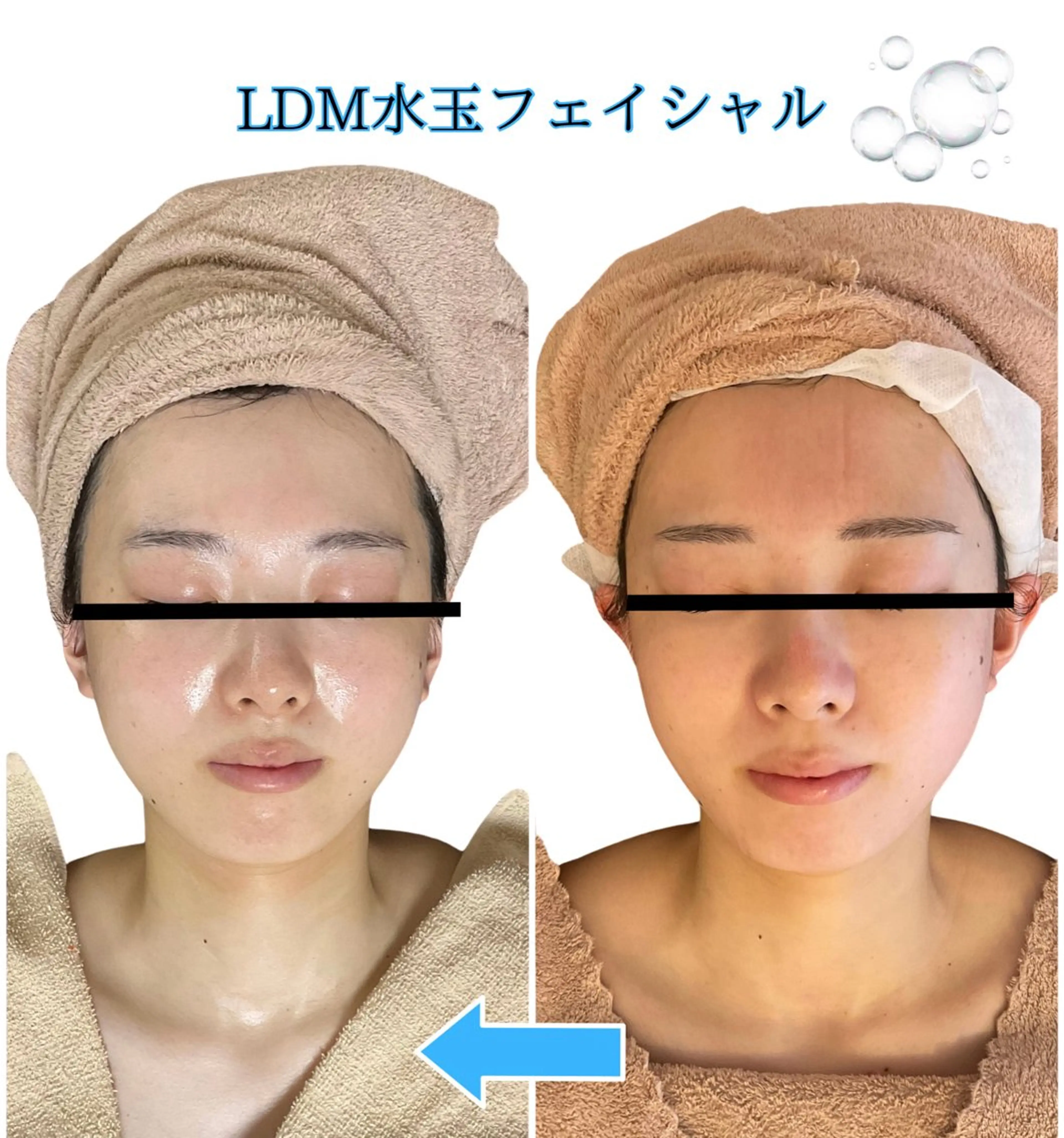 【韓国水光肌】LDM水玉フェイシャル60分の写真