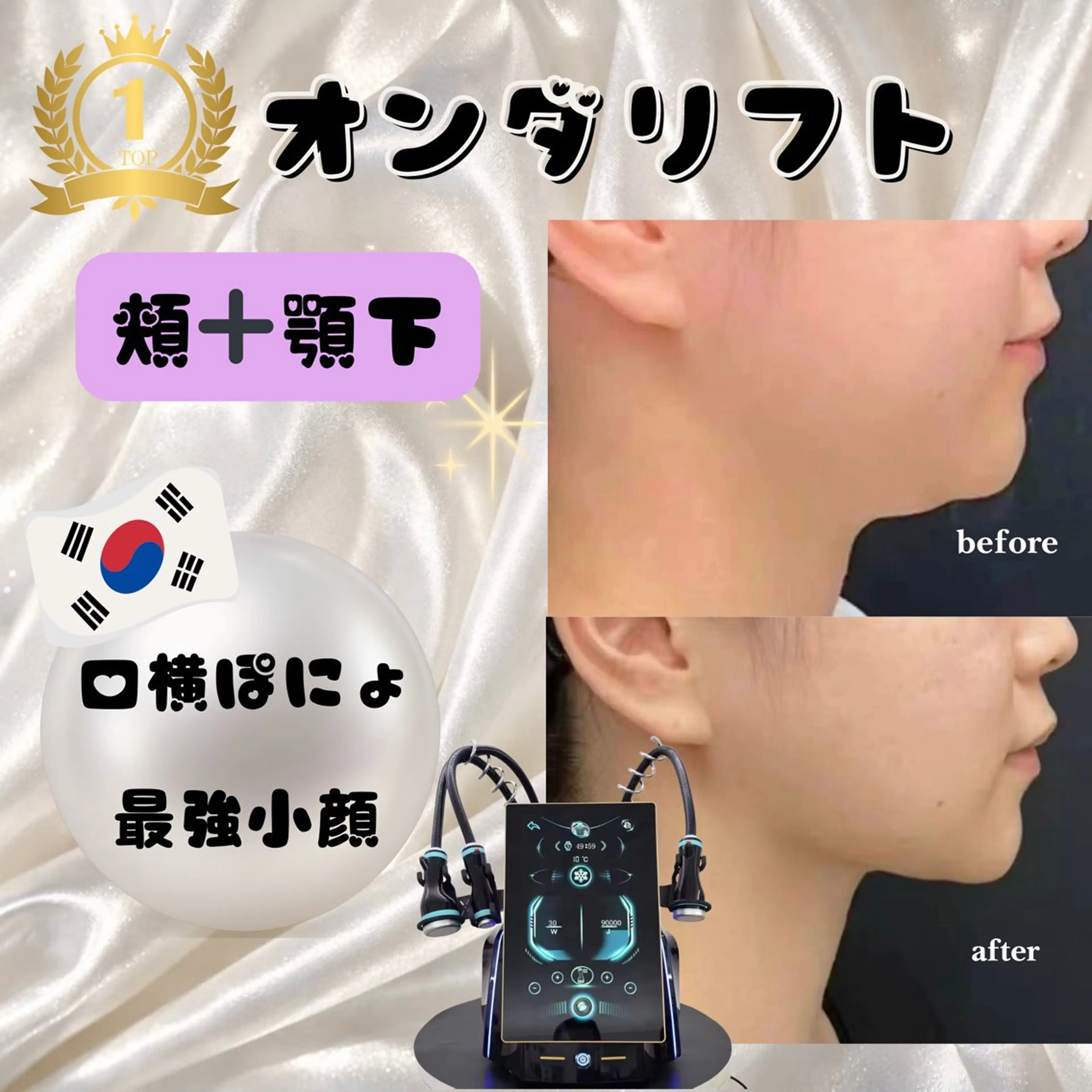 オンダリフト30分｜頬~顎下80kj~140kjの写真