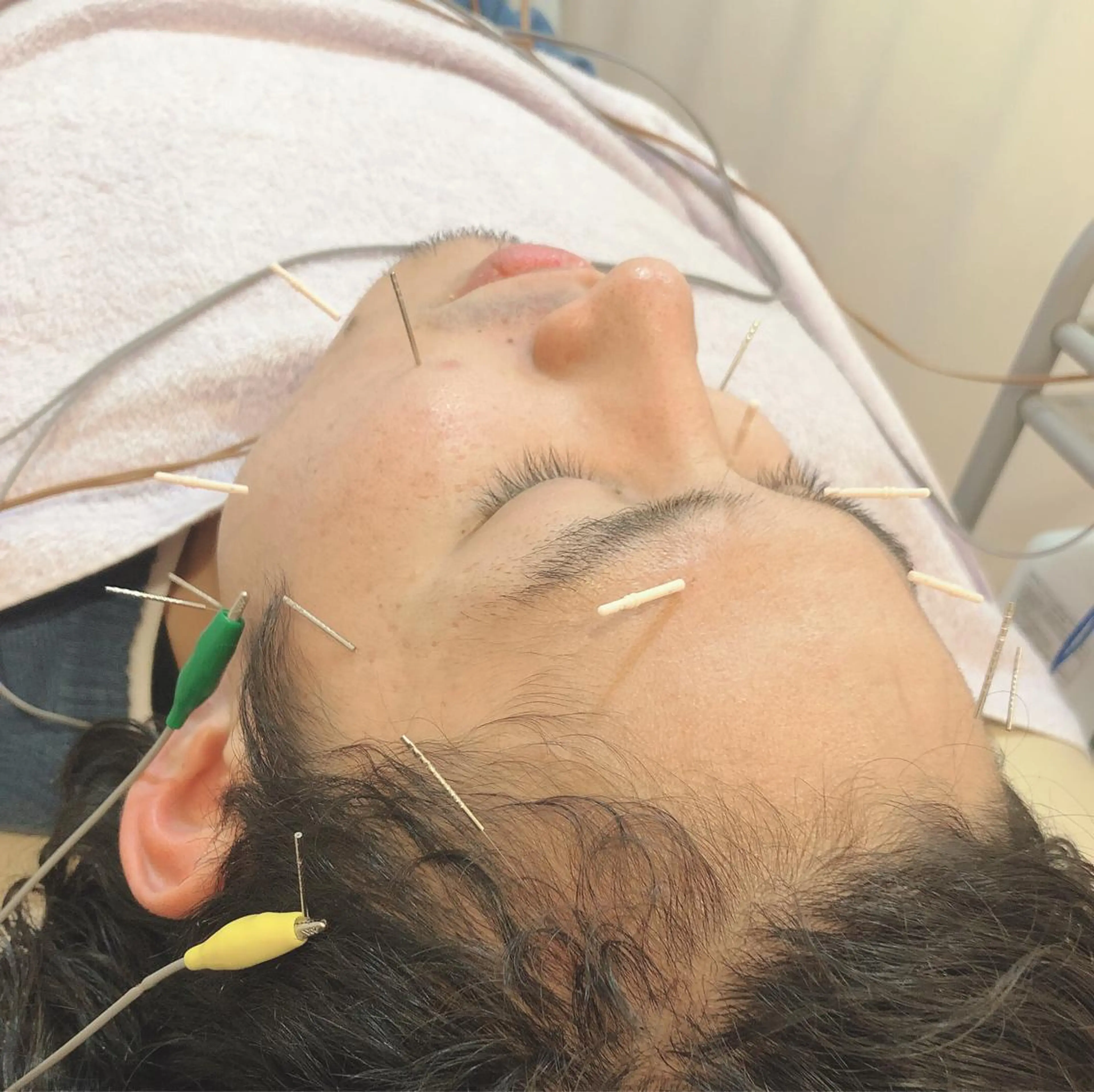 メンズ リフトアップ・たるみ ☆美容鍼小顔矯正のその他イメージ