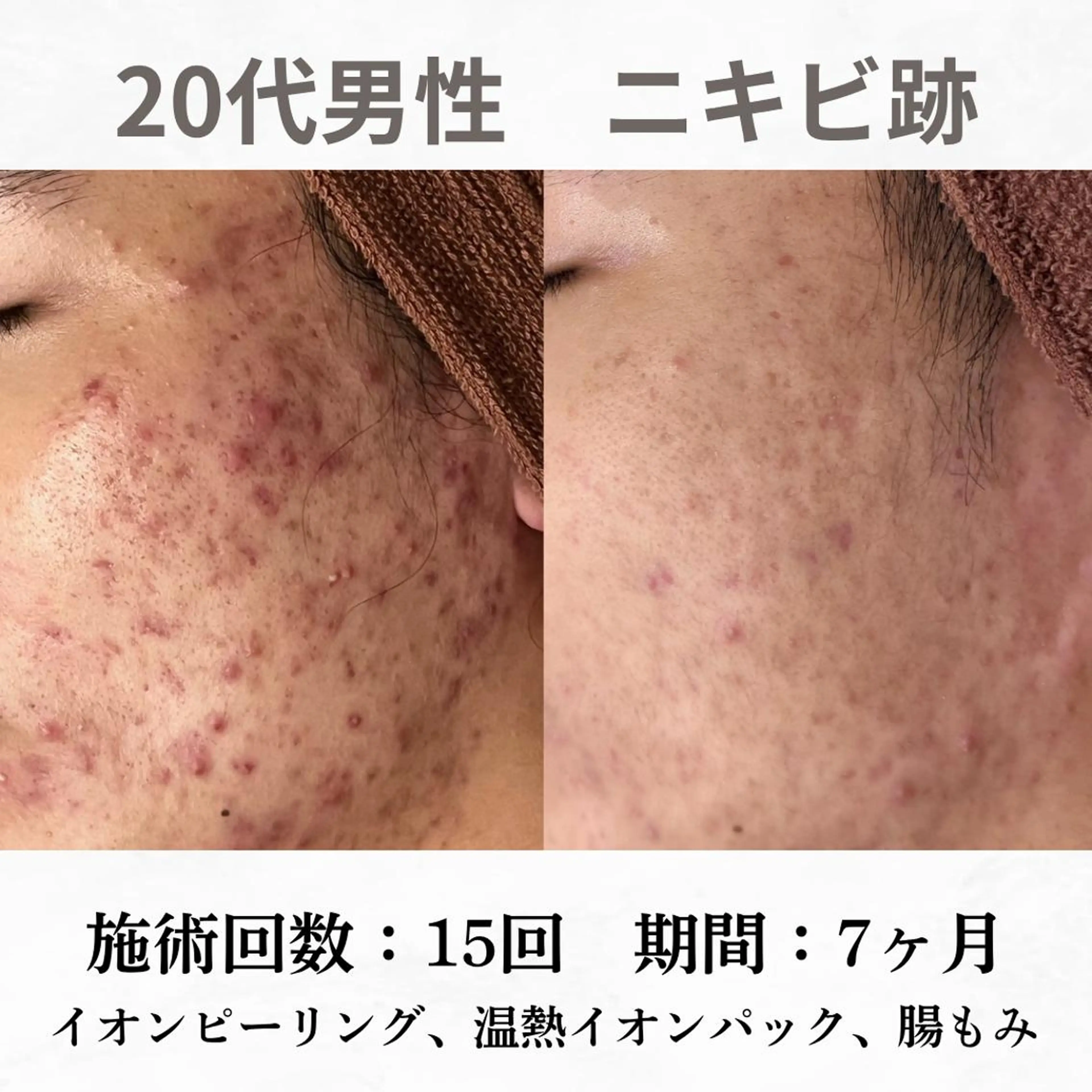 重度ニキビ専門🌷 ダウンタイムなしのエステ・リラクイメージ