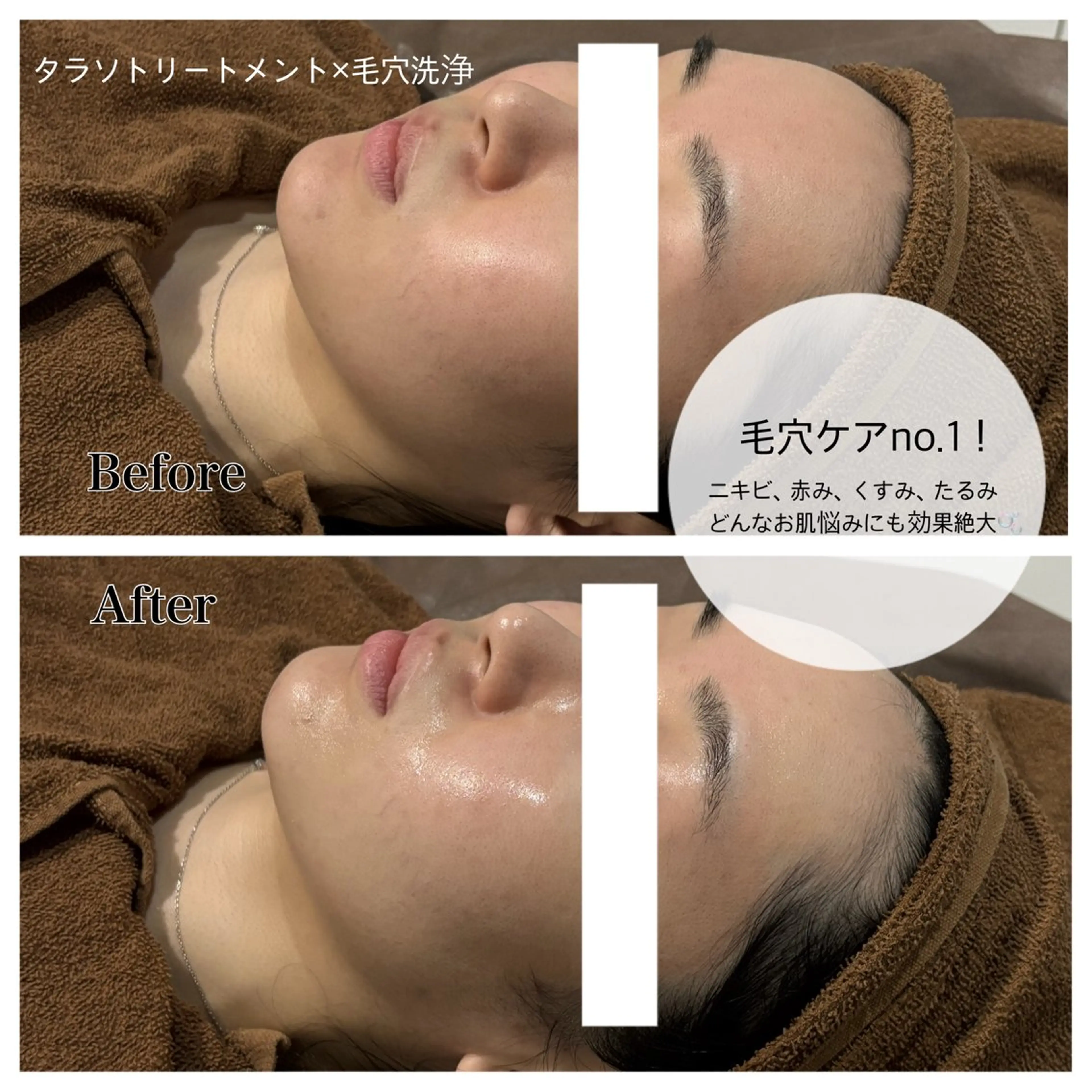 【黒ずみ×くすみ効果no.1ケア】タラソトリートメント×毛穴洗浄💆🏼‍♀️✨リンパマッサージ付き♪の写真