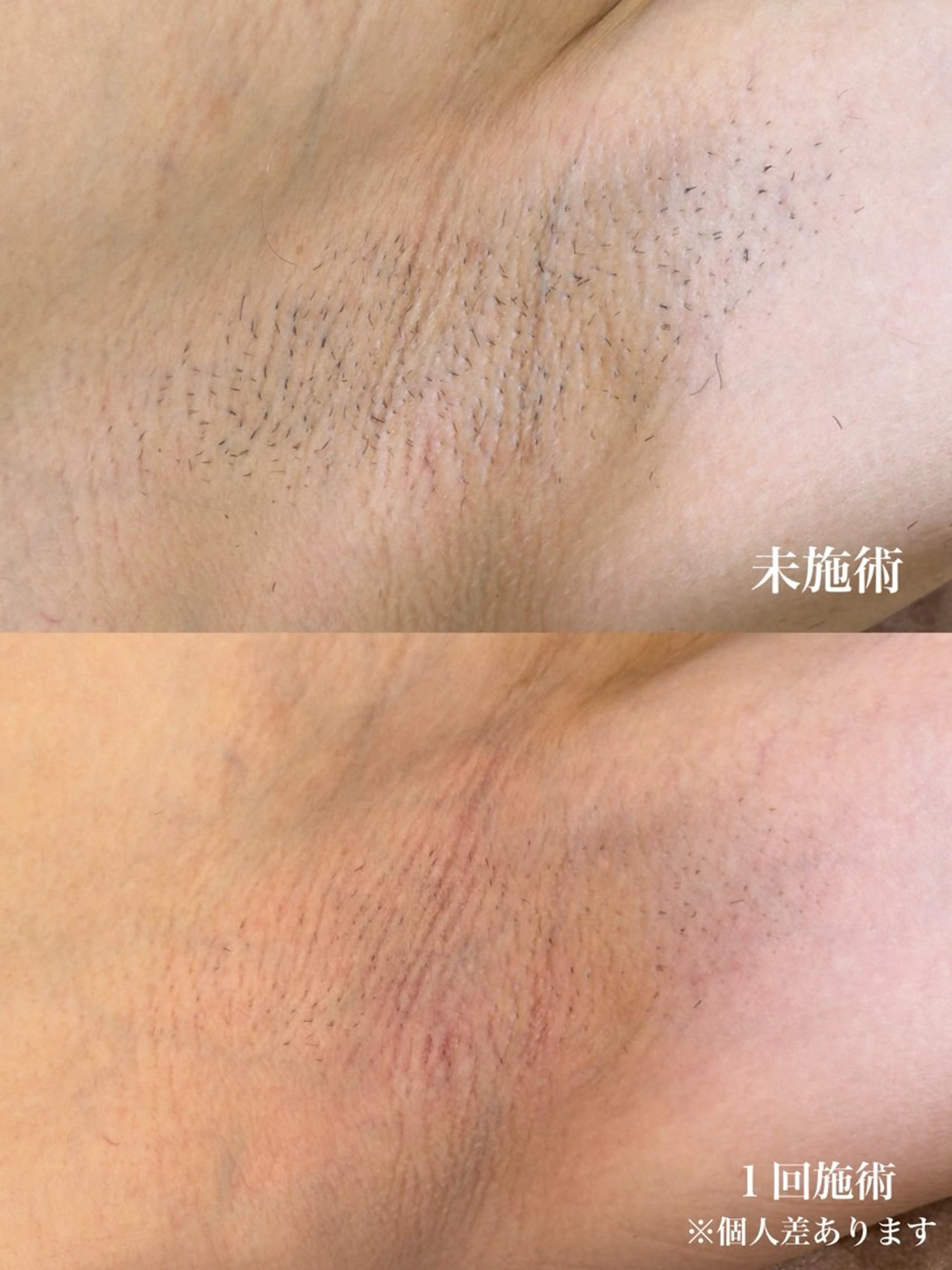 メンズワキ脱毛の写真