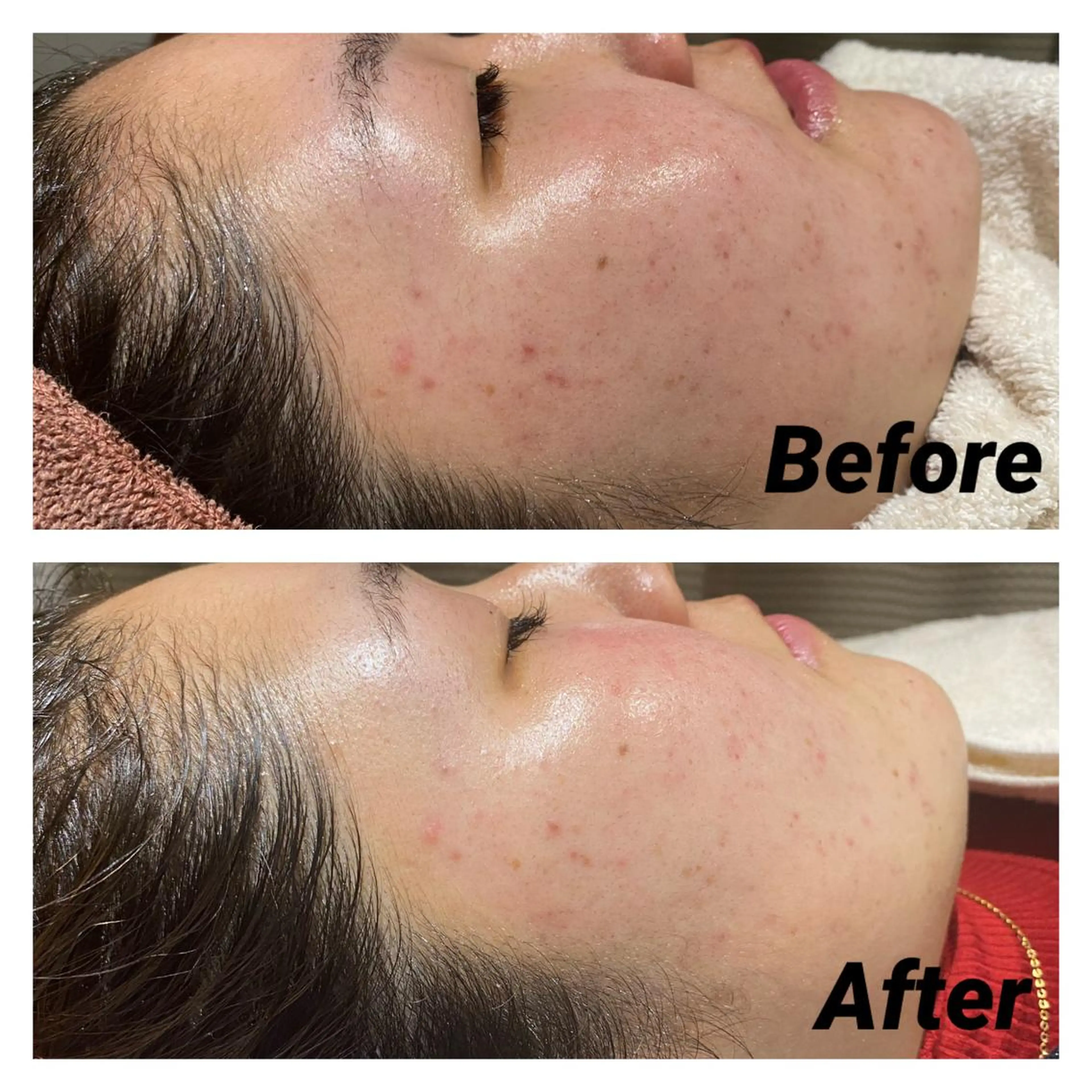 【赤ニキビ改善】 BELL'ET新宿店のエステ・リラクイメージ