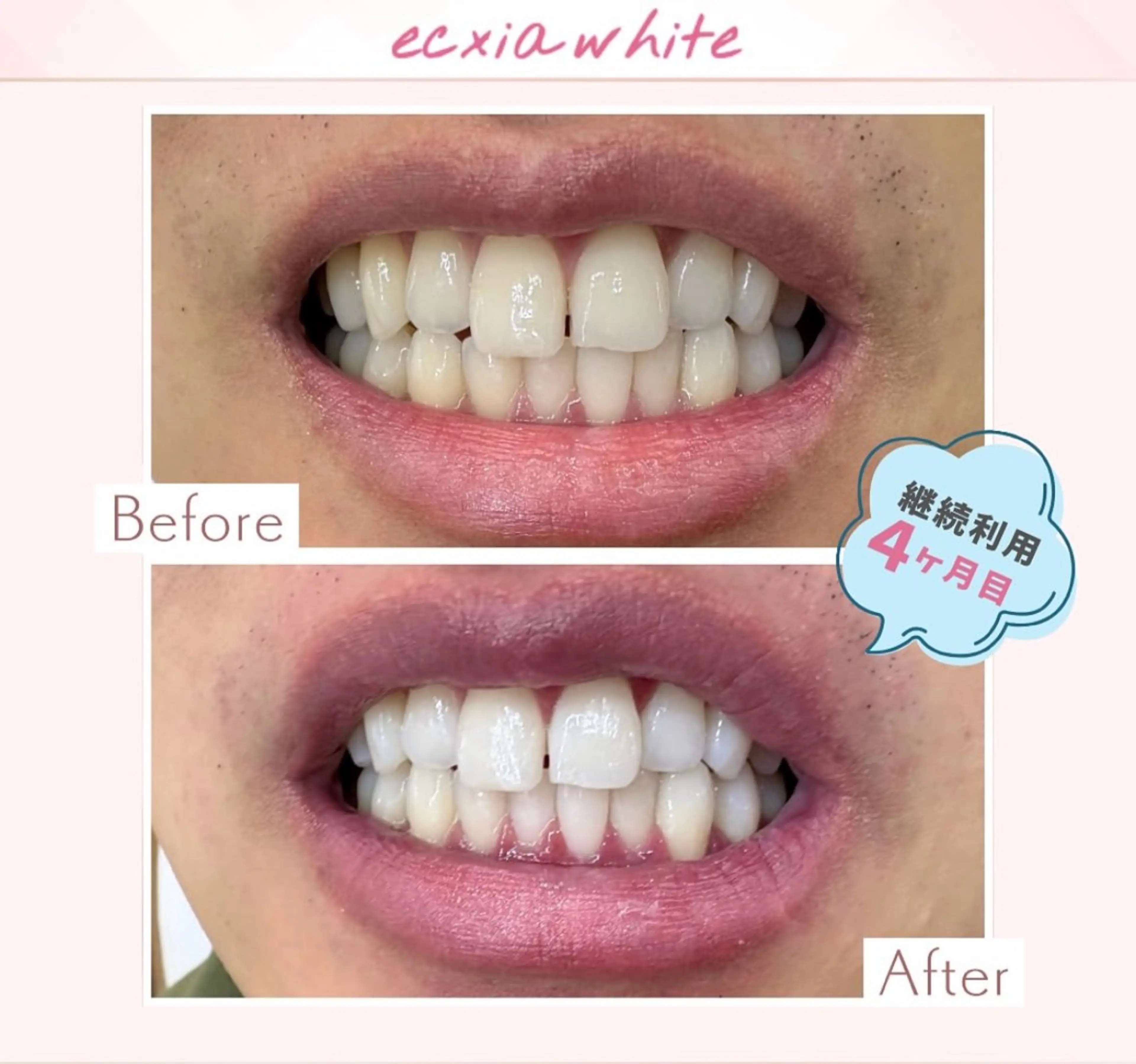 エクシアホワイト調布所属・yumi❤︎ ホワイトニングのその他イメージ