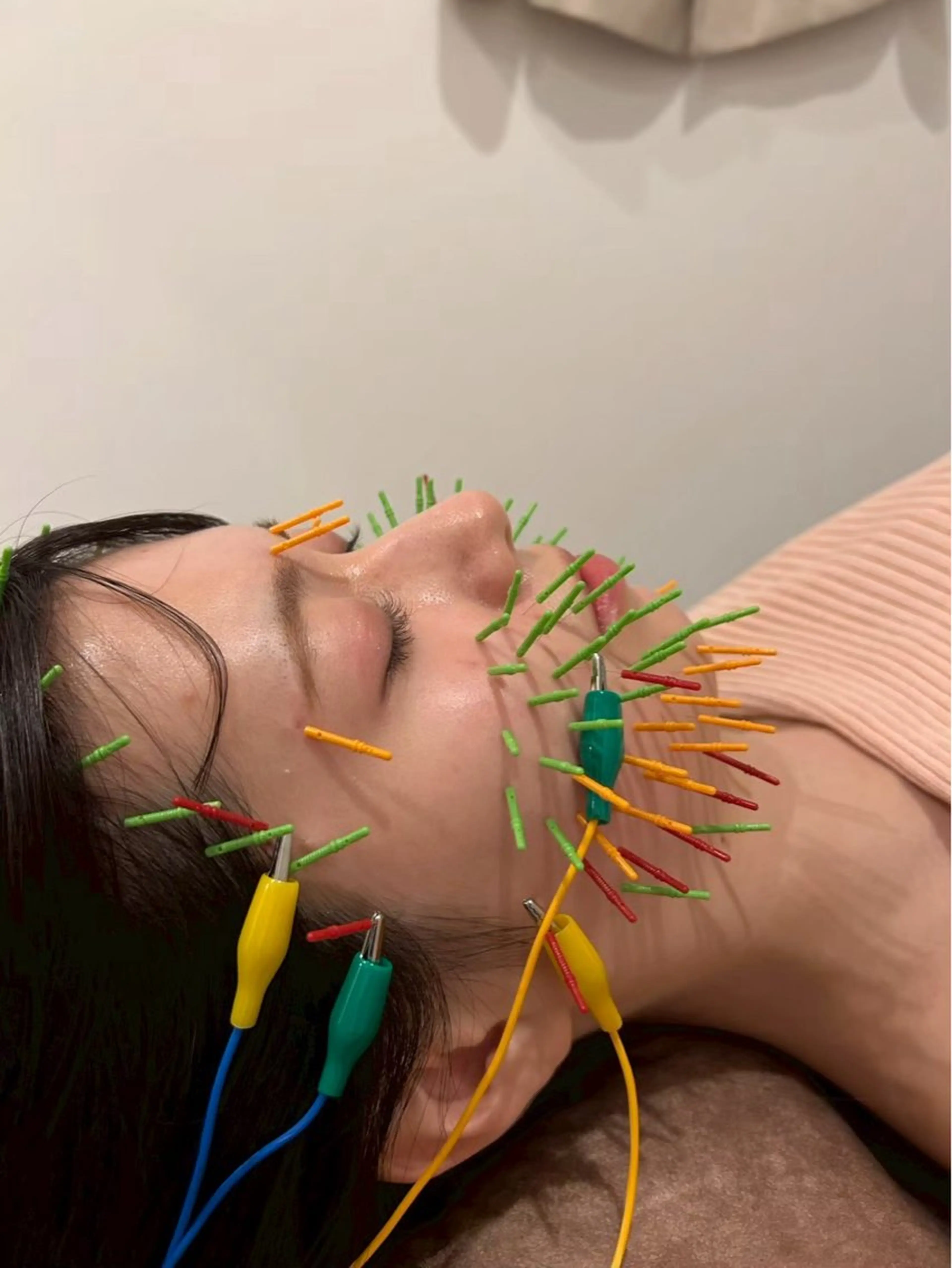 エステ リラク 美容鍼灸Solana所属・肌質改善×美容鍼 ゆいのエステ・リラクイメージ