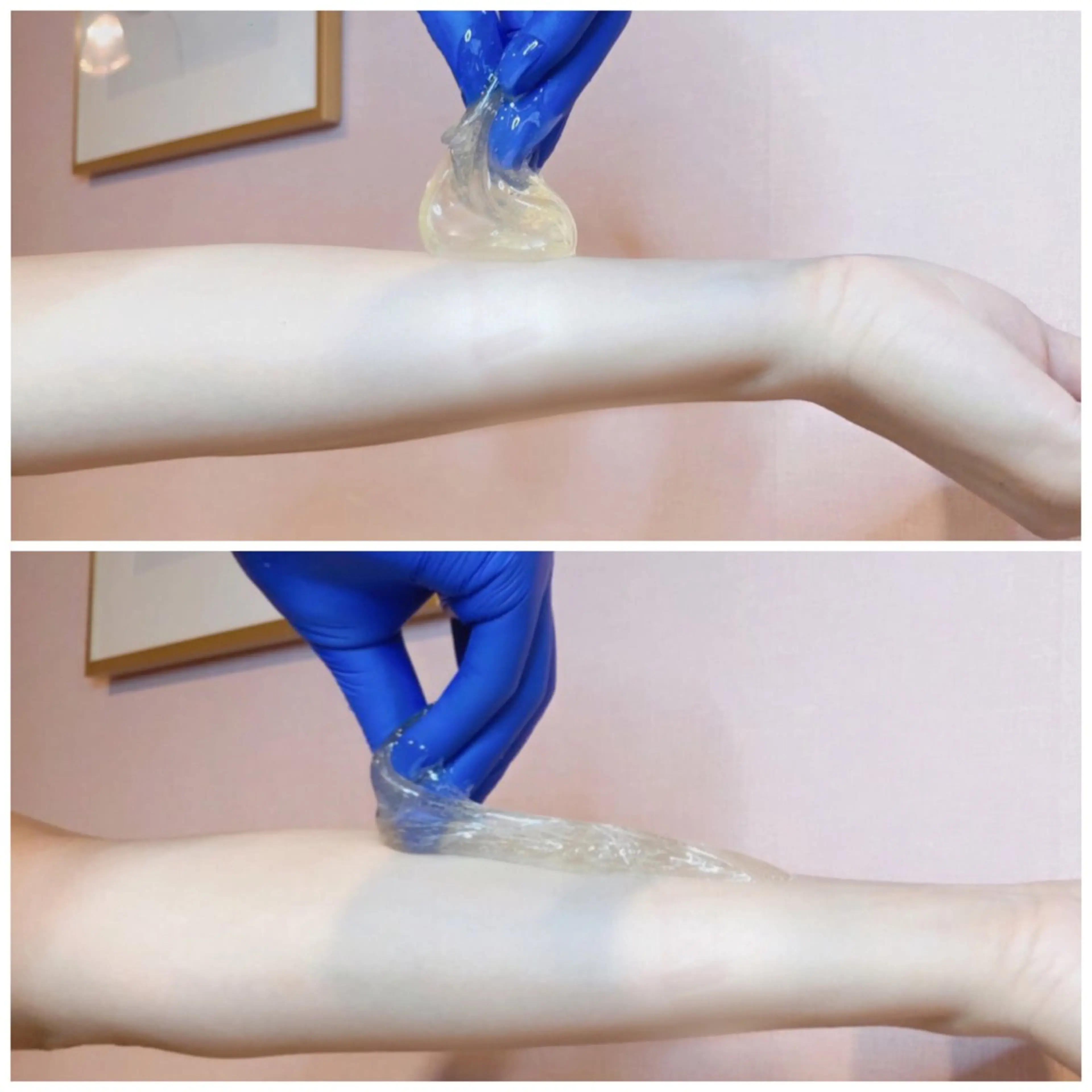 ブラジリアン(VIO)+フェイスのセットの写真