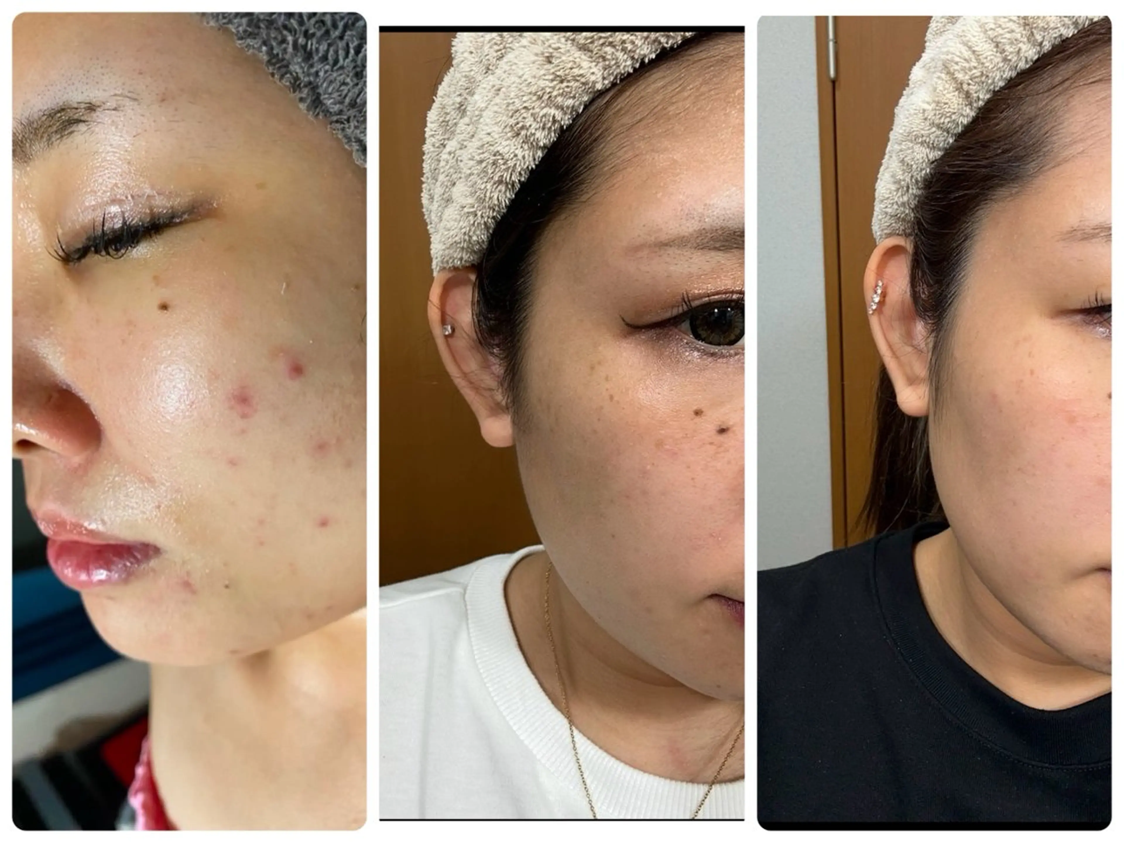 ニキビ毛穴専門店Beautysalon Luana所属・小林 まいのエステ・リラクイメージ