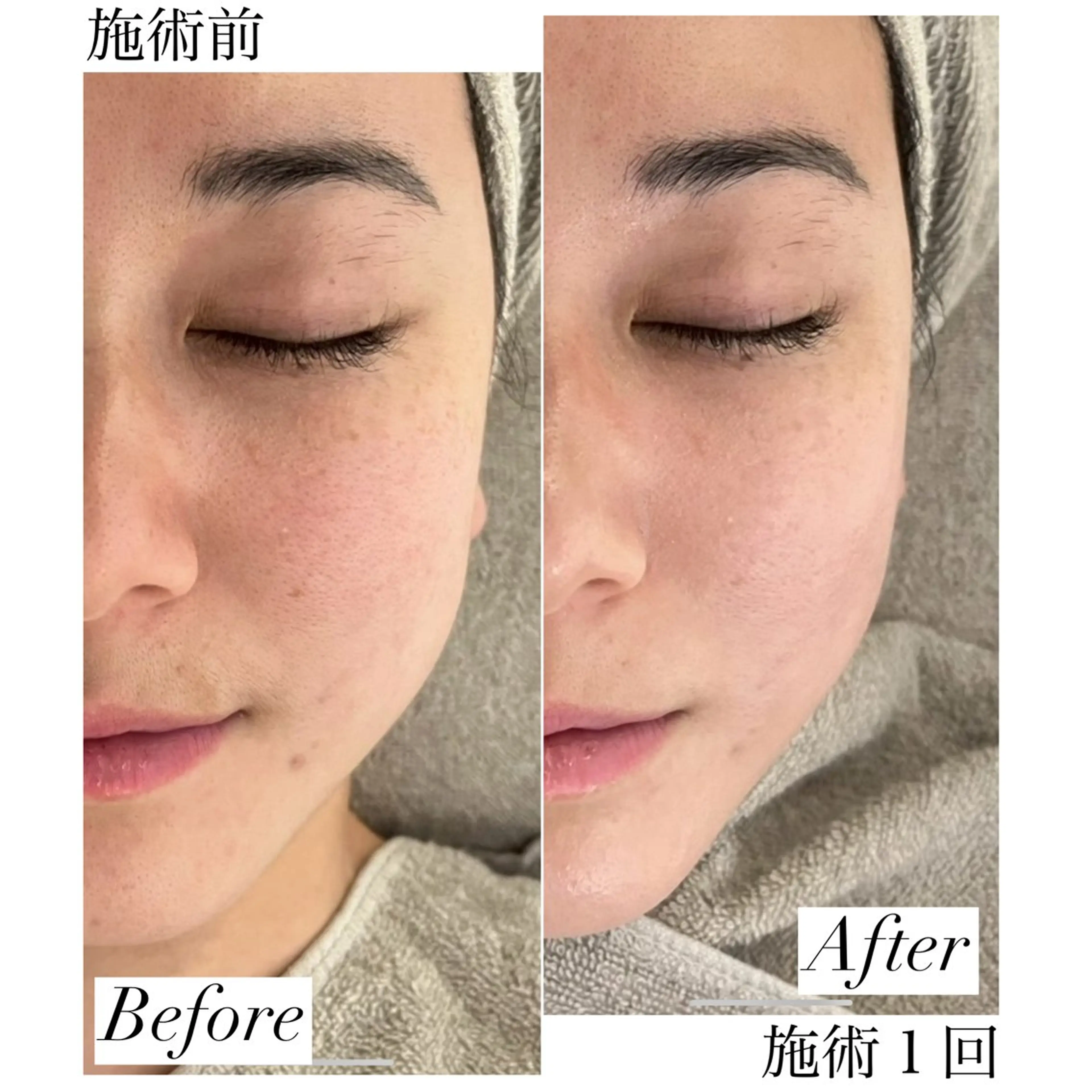 EXOMEREプレミアム(70分施術)カウンセリング別の写真