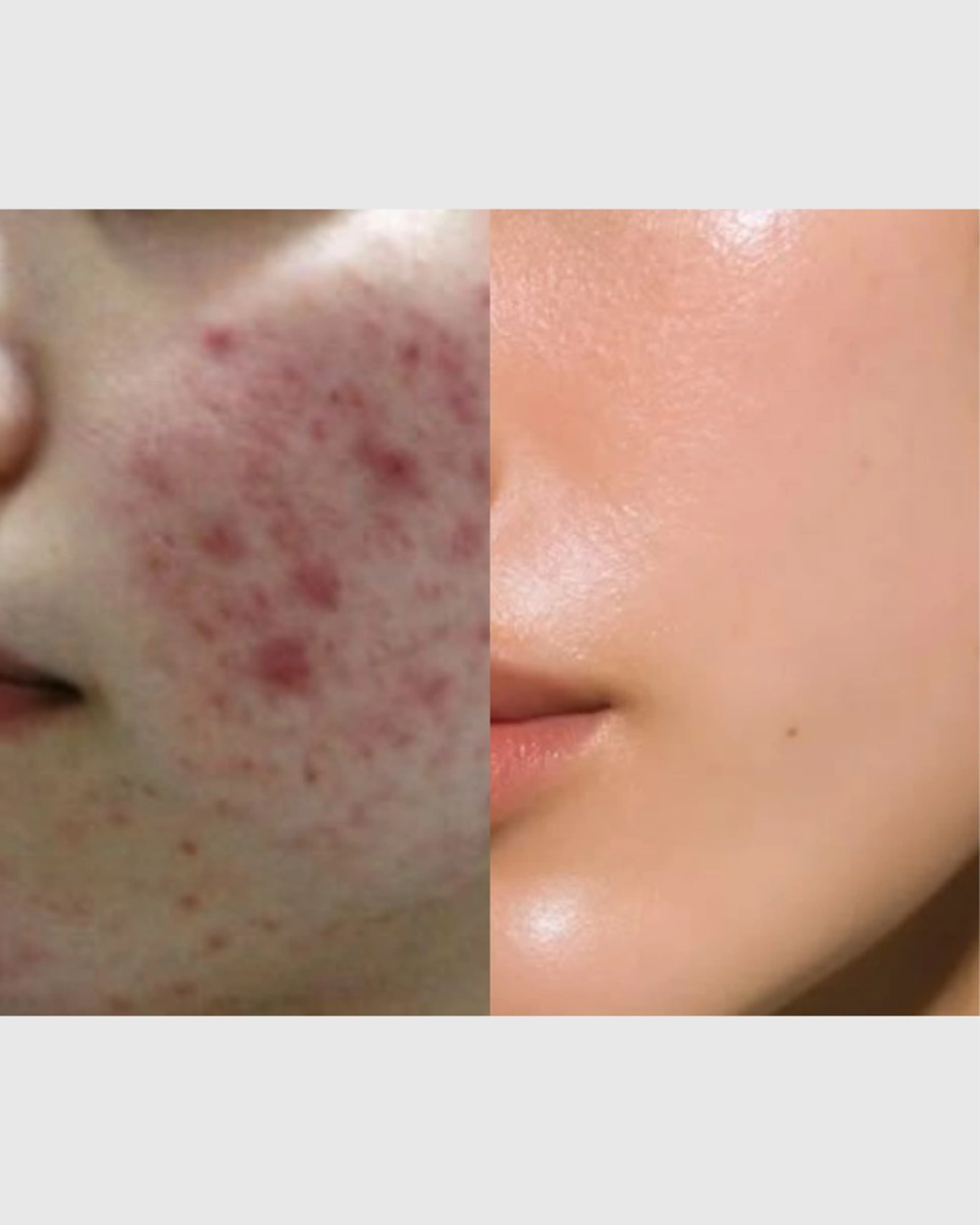 【初回限定】大人ニキビケア｜美容鍼×フェイシャルケアの写真