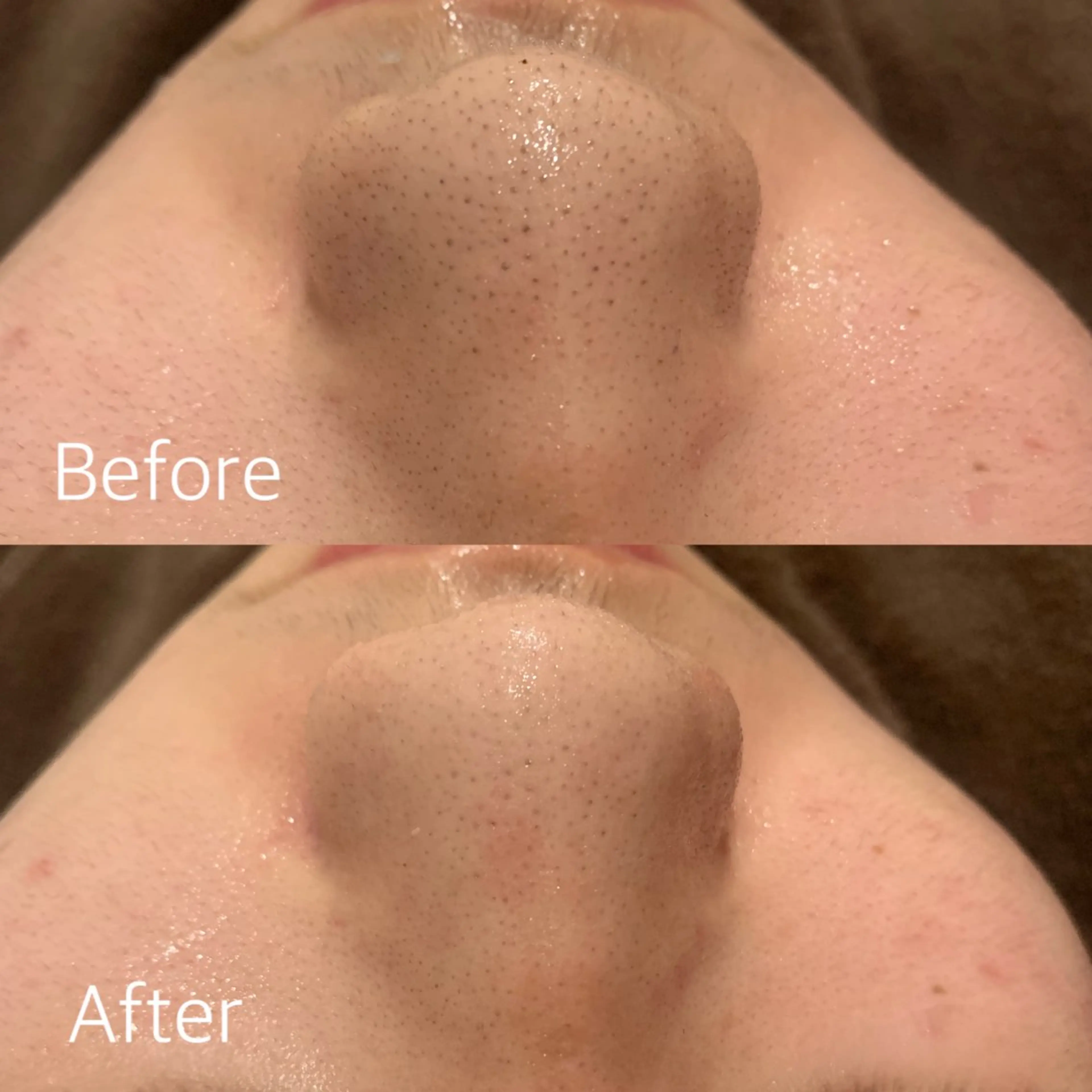 【学割U24初回】学生さん応援★毛穴洗浄¥11,000→¥5,980【クチコミ限定価格】の写真