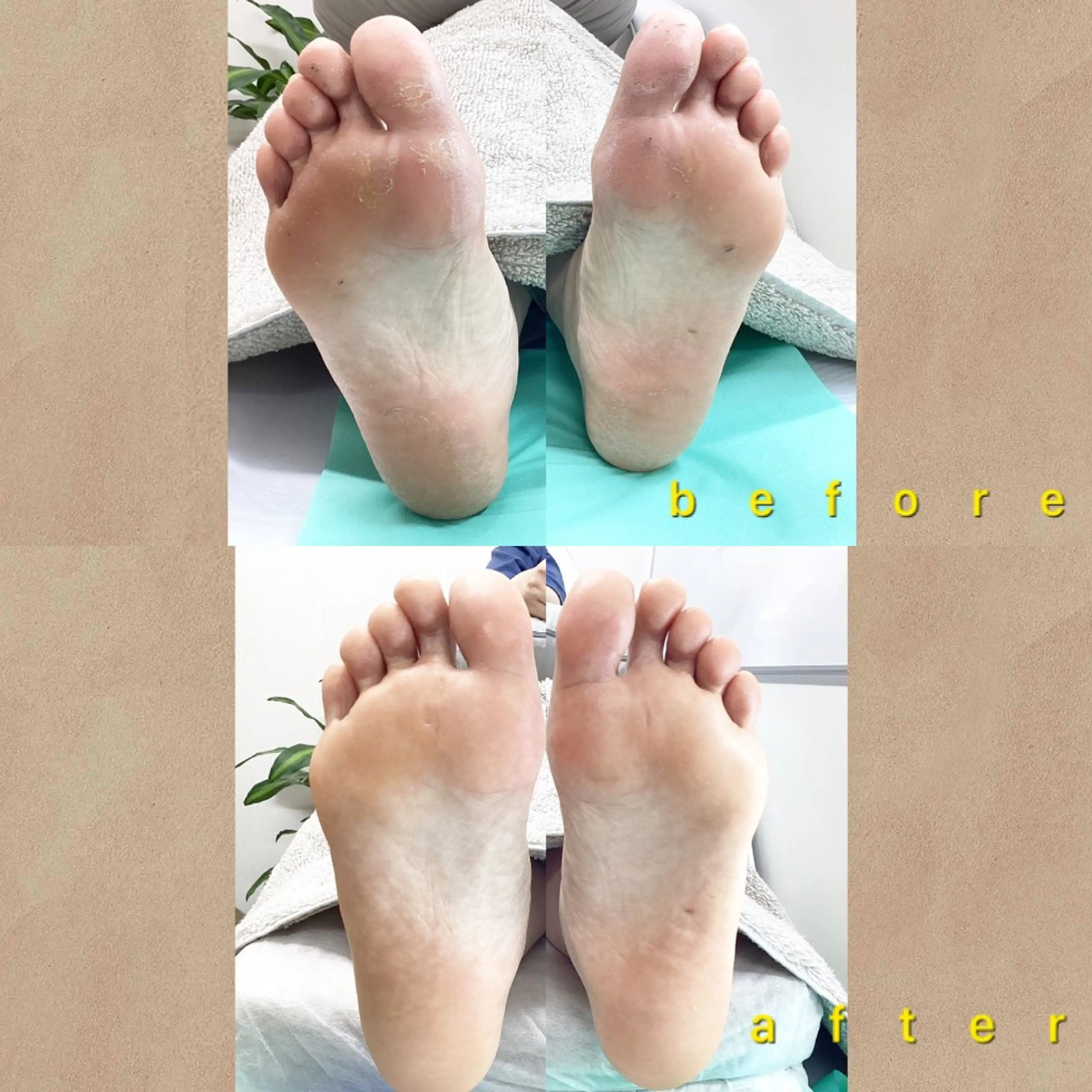 その他 巻き爪補正店 大阪なんば店のネイルデザイン