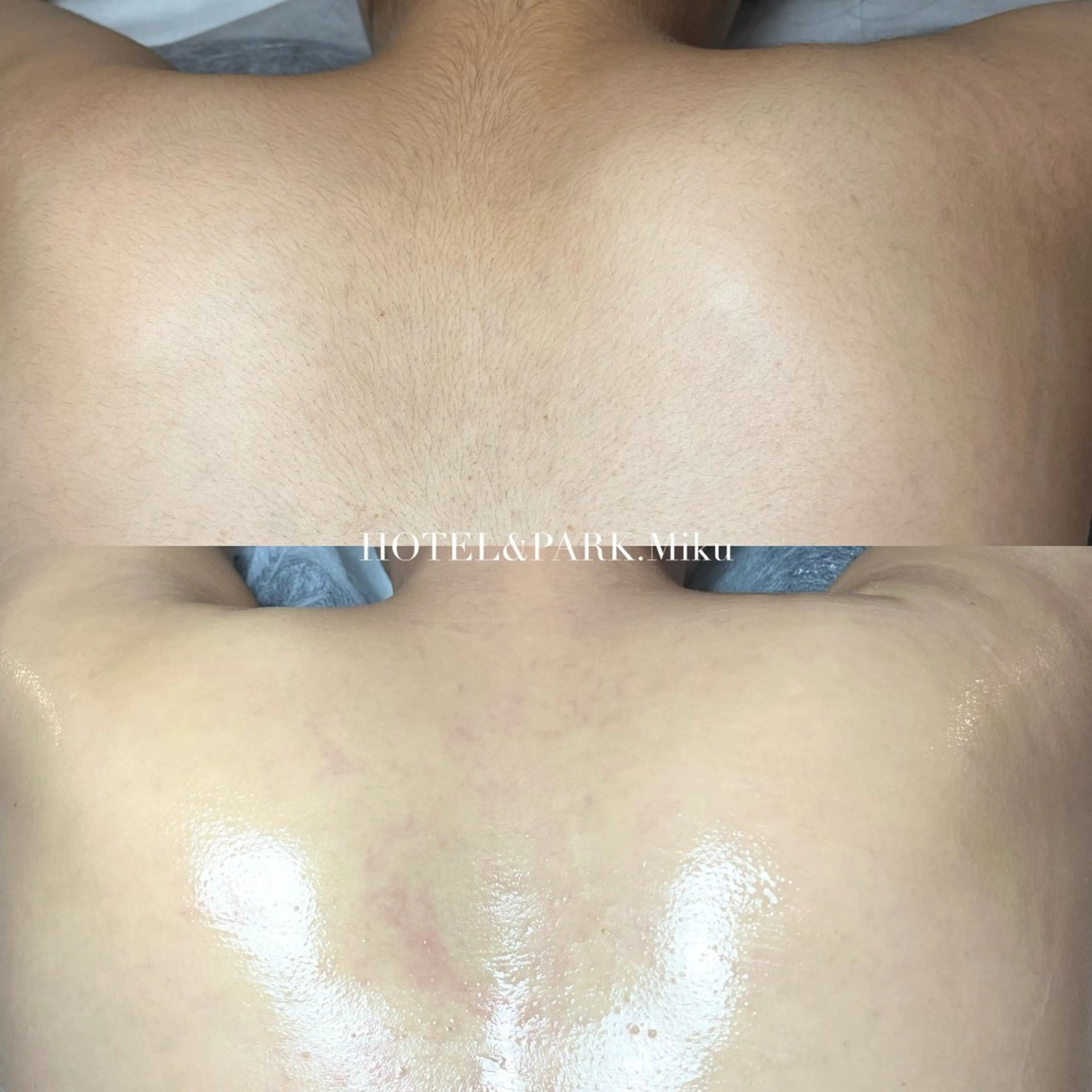 人気No.2❤️🛒【背中上*うなじ込ワックス脱毛】の写真