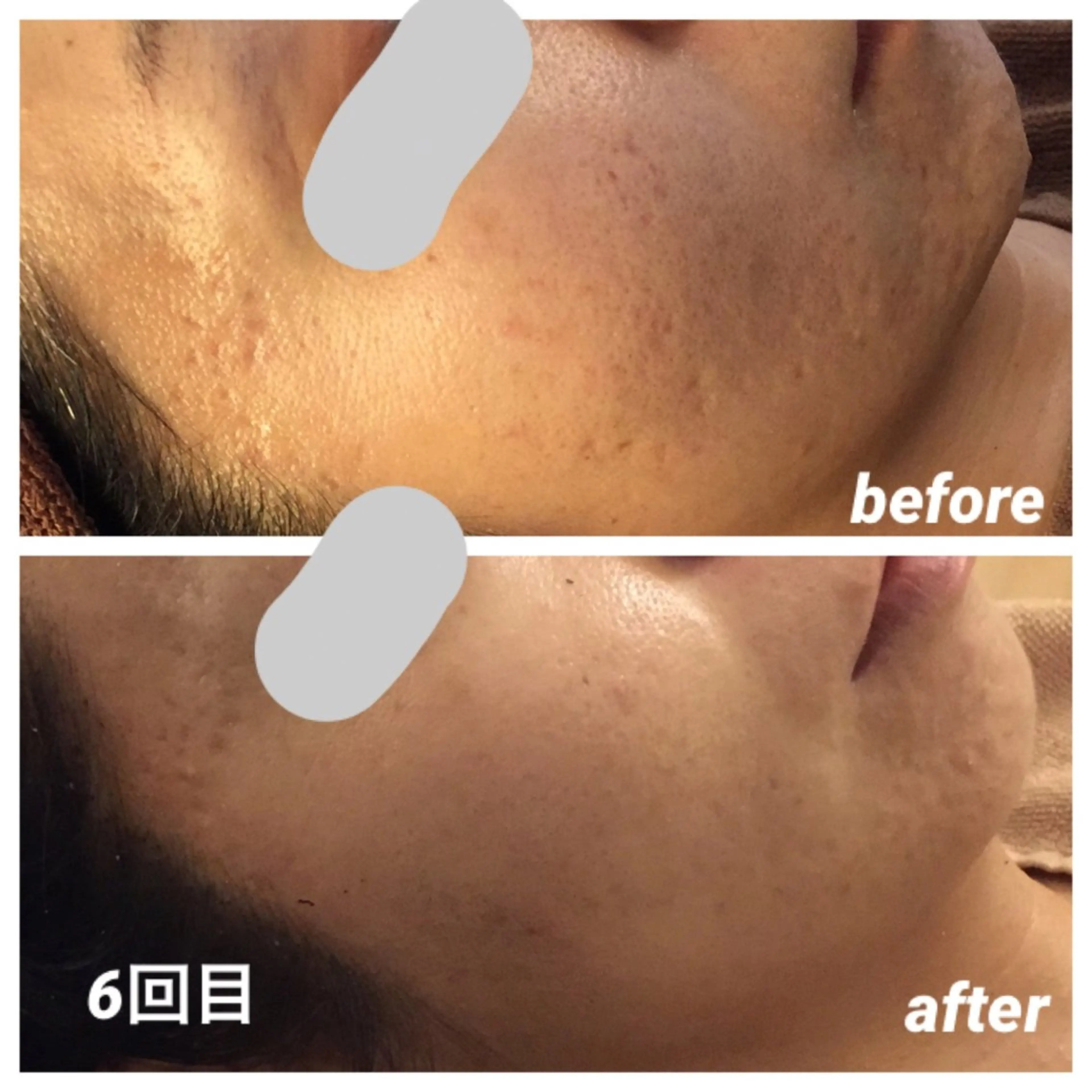 エステ 毛穴ニキビ専門 ビューティーグランツのエステ・リラクイメージ