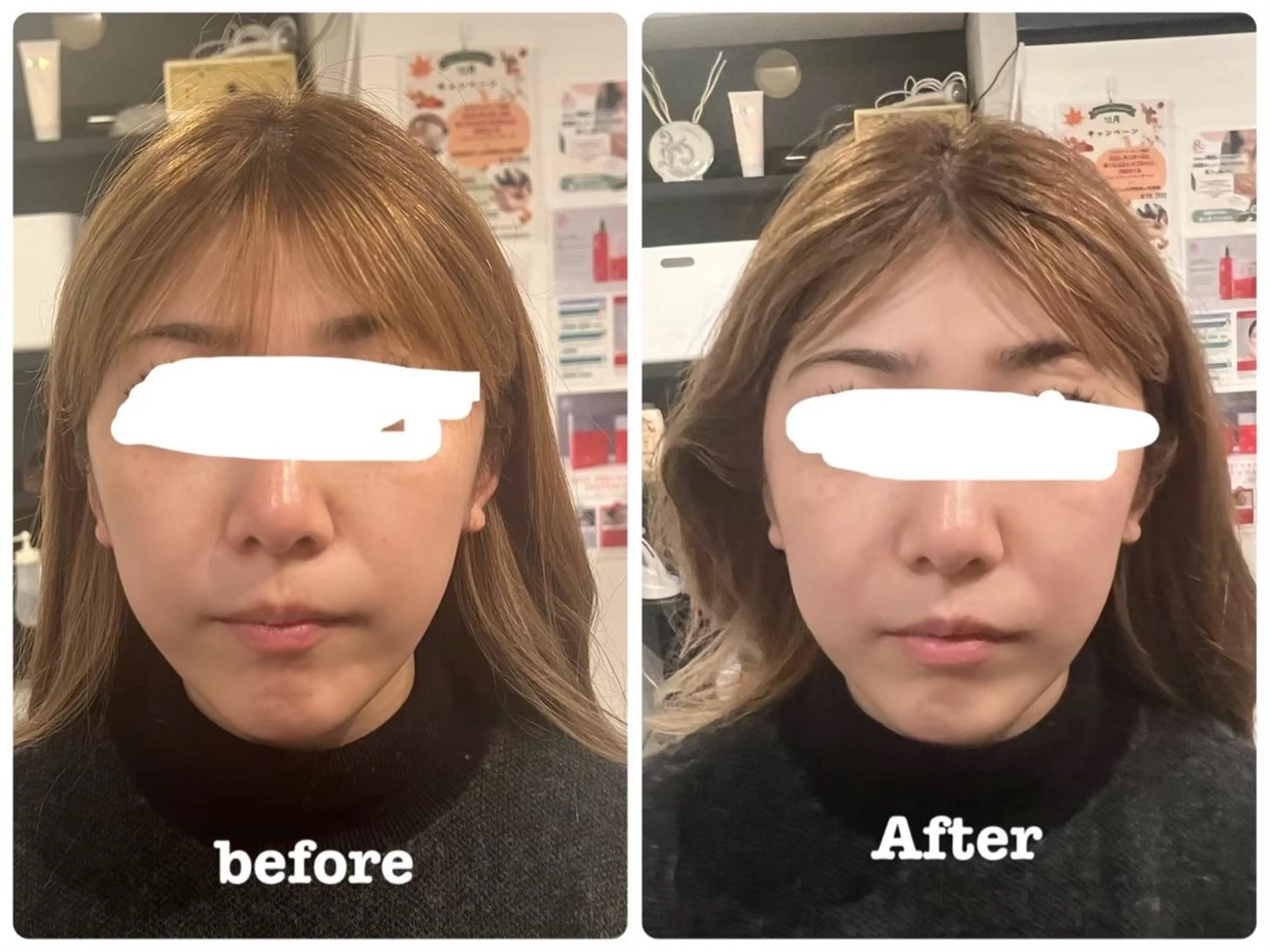 【ミニモ限定】スッキリ✨小顔矯正🩷の写真