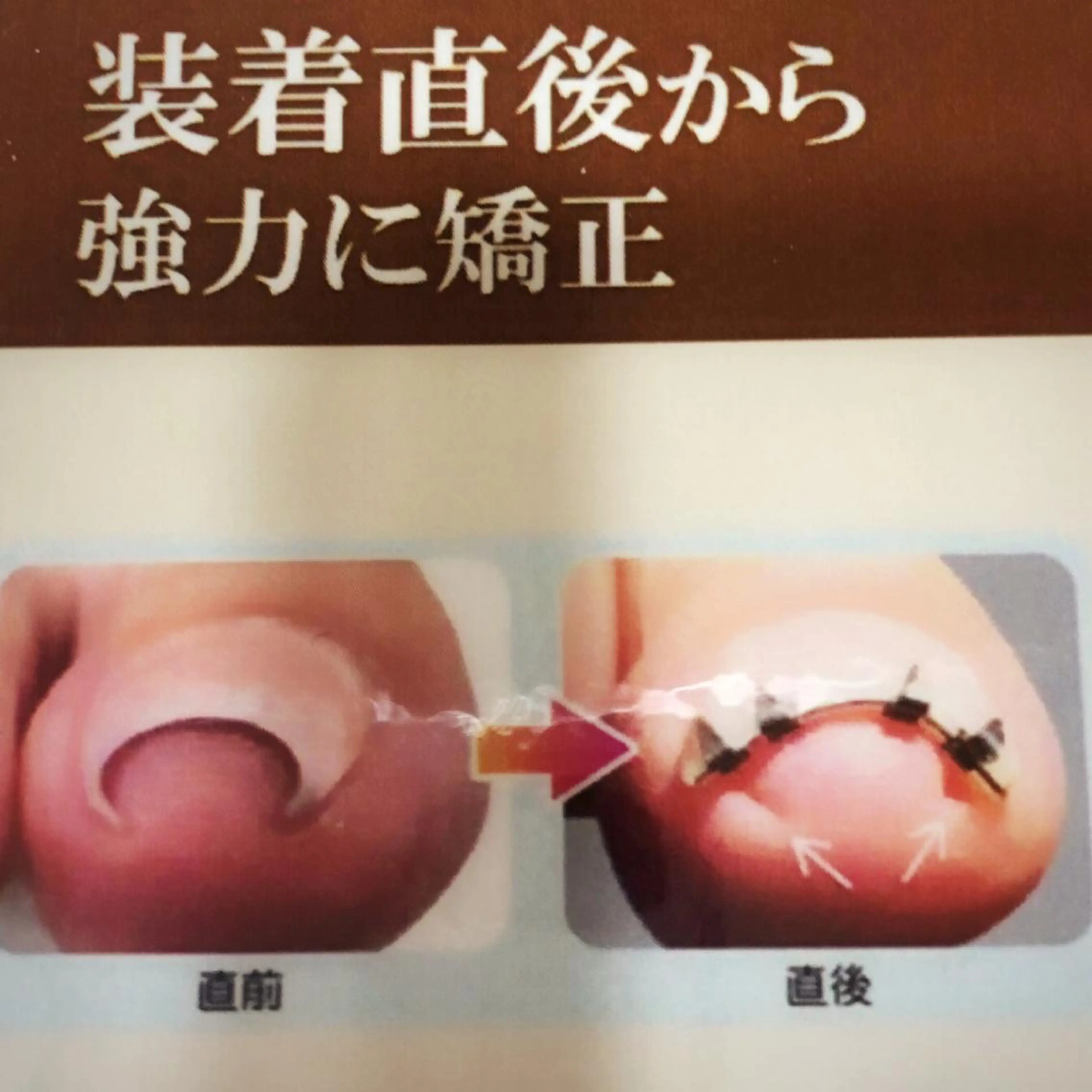 巻き爪矯正👣矯正器具持ち込み（片足1本）巻き爪リフト装着＋クリアジェルでコーティング付きの写真