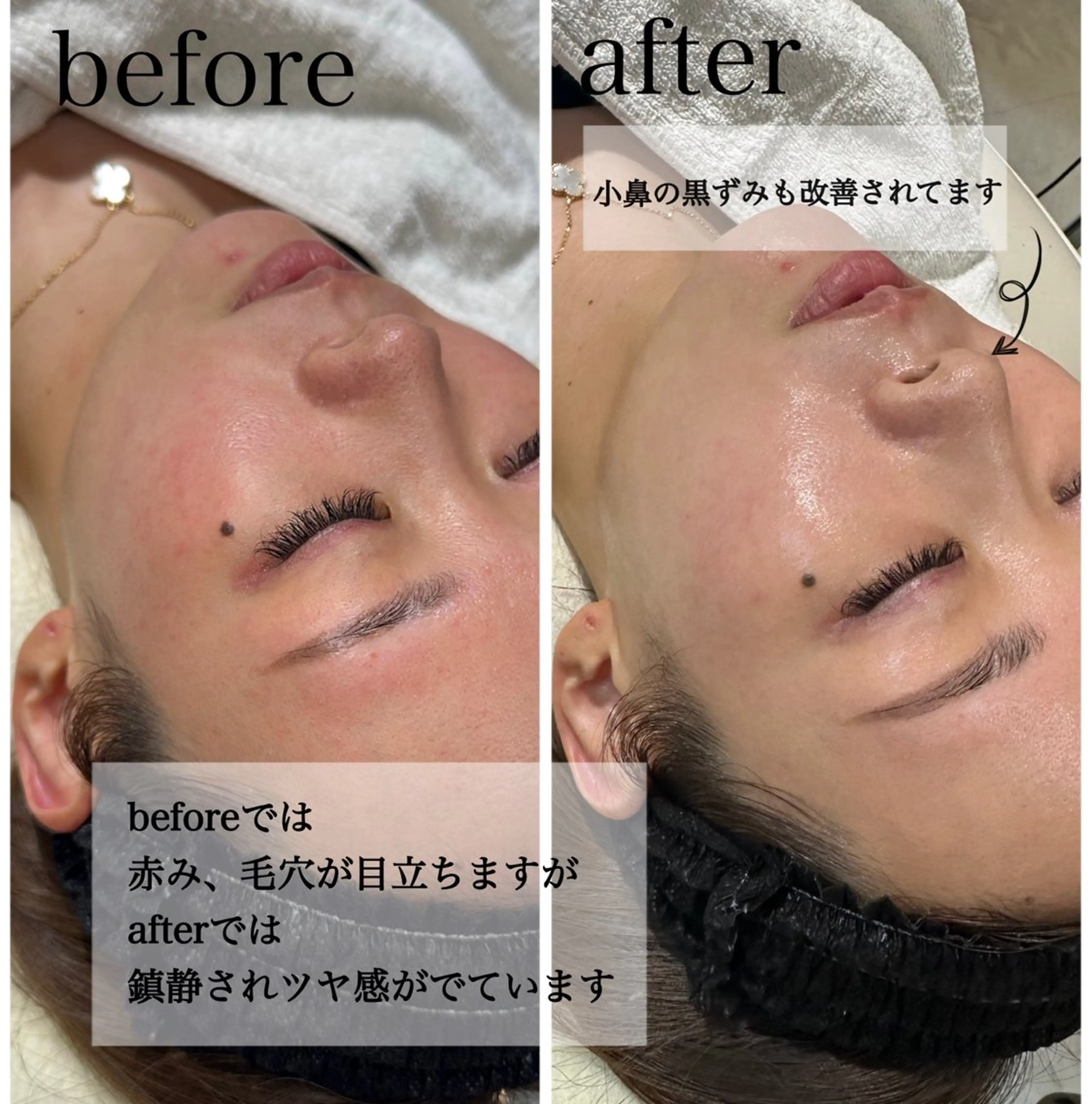 【韓国肌管理/ララピール】韓国大人気第4世代ピーリング/高濃度パック付/艶肌/肌質改善/低刺激/敏感肌◎/ダウンタイム×の写真