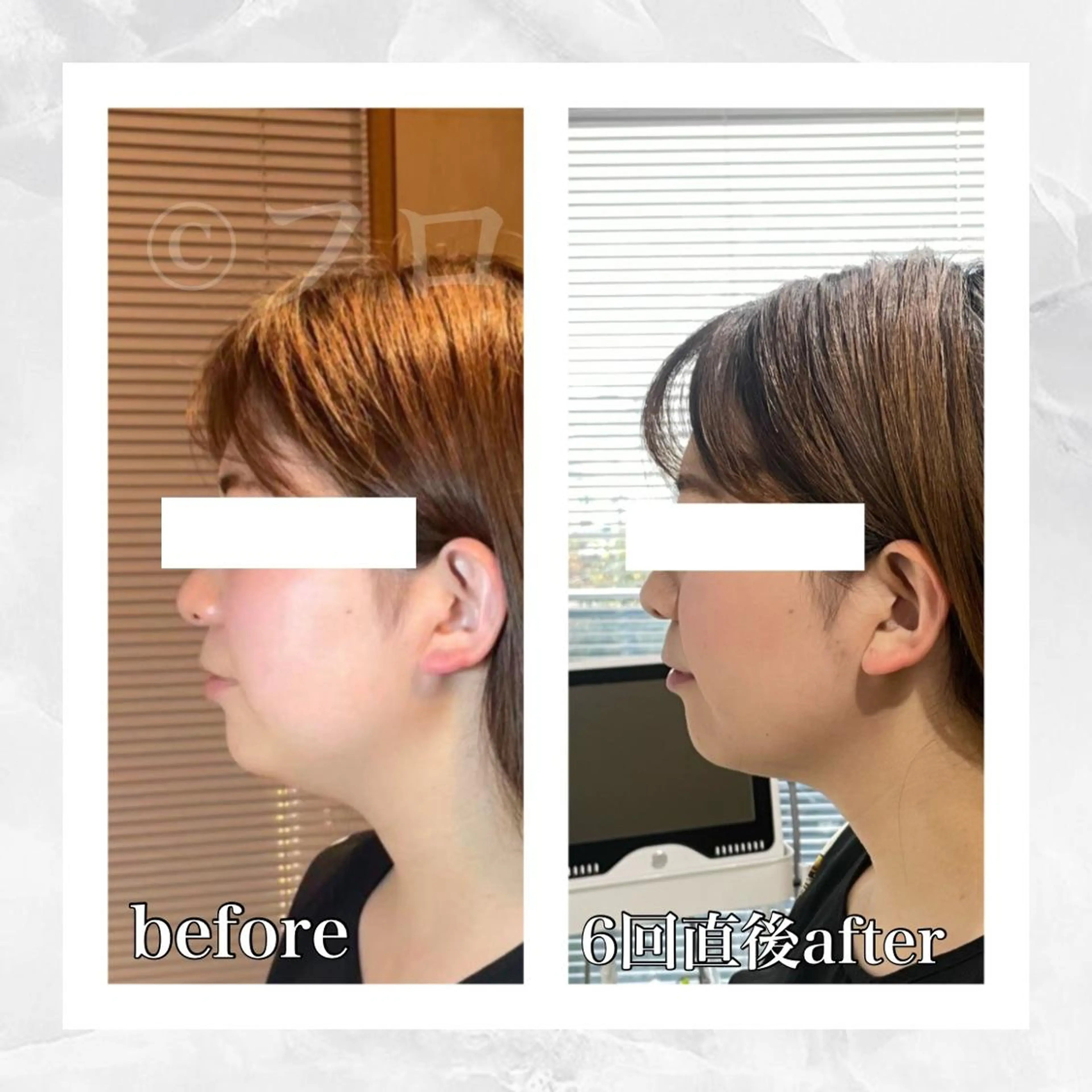 人気No1【フェイスラインをくっきり】もたつき改善!横顔に自信!小顔初回体験の写真