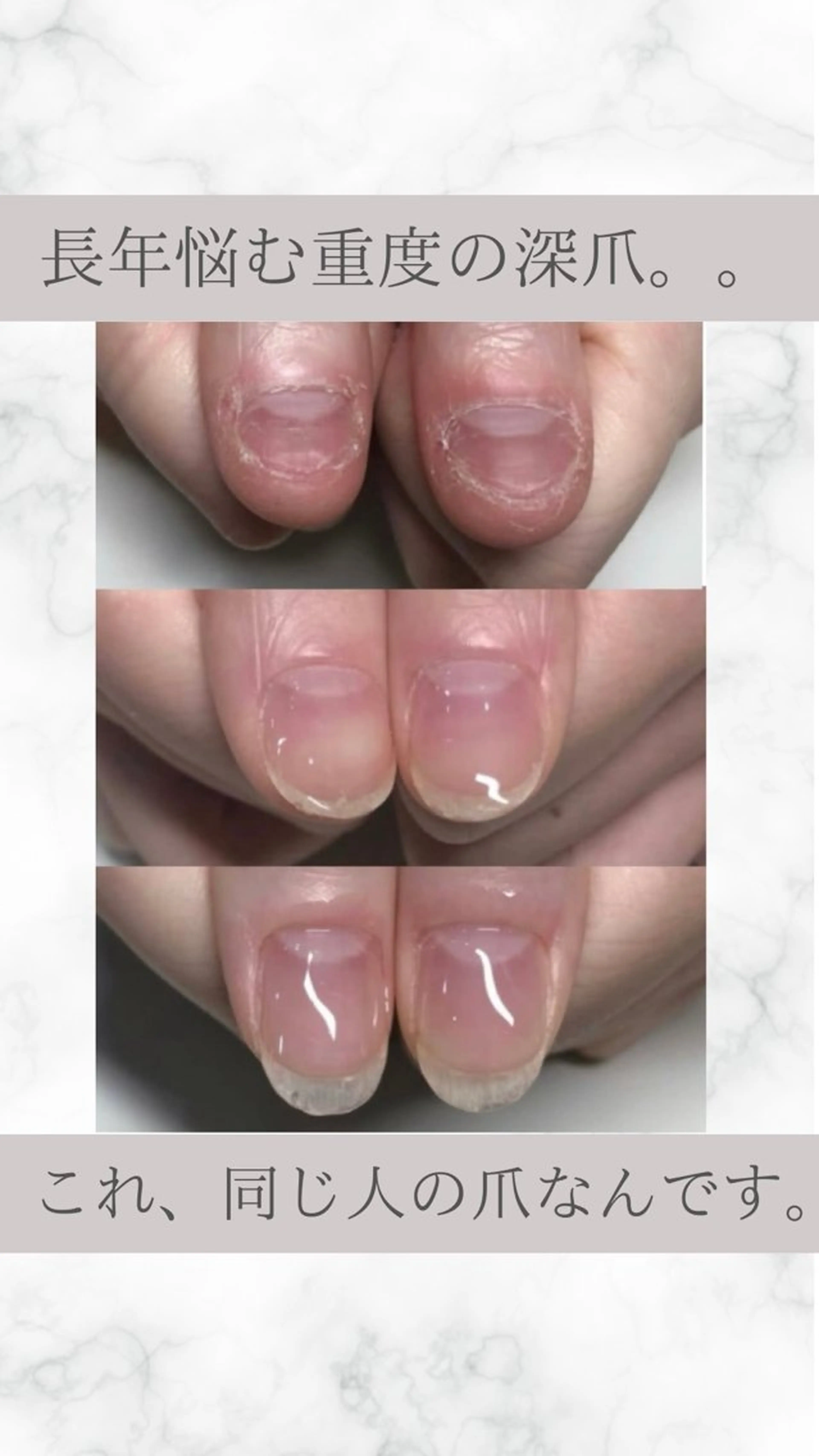 ネイル ハンドネイル ティアラネイル 宇都宮深爪矯正のネイルデザイン