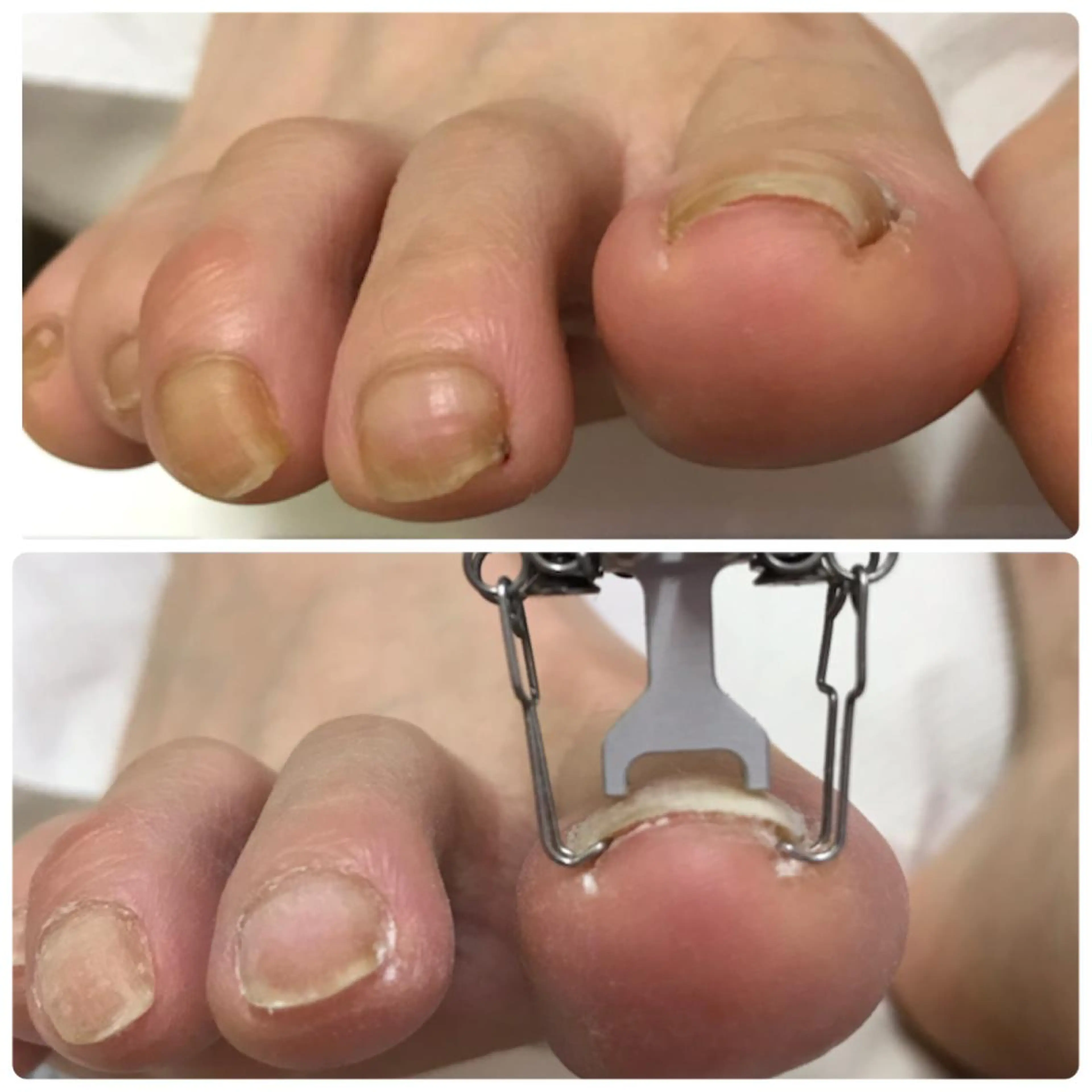 ネイル フットネイル 深爪を断らない スカルプ高評価店のネイルデザイン