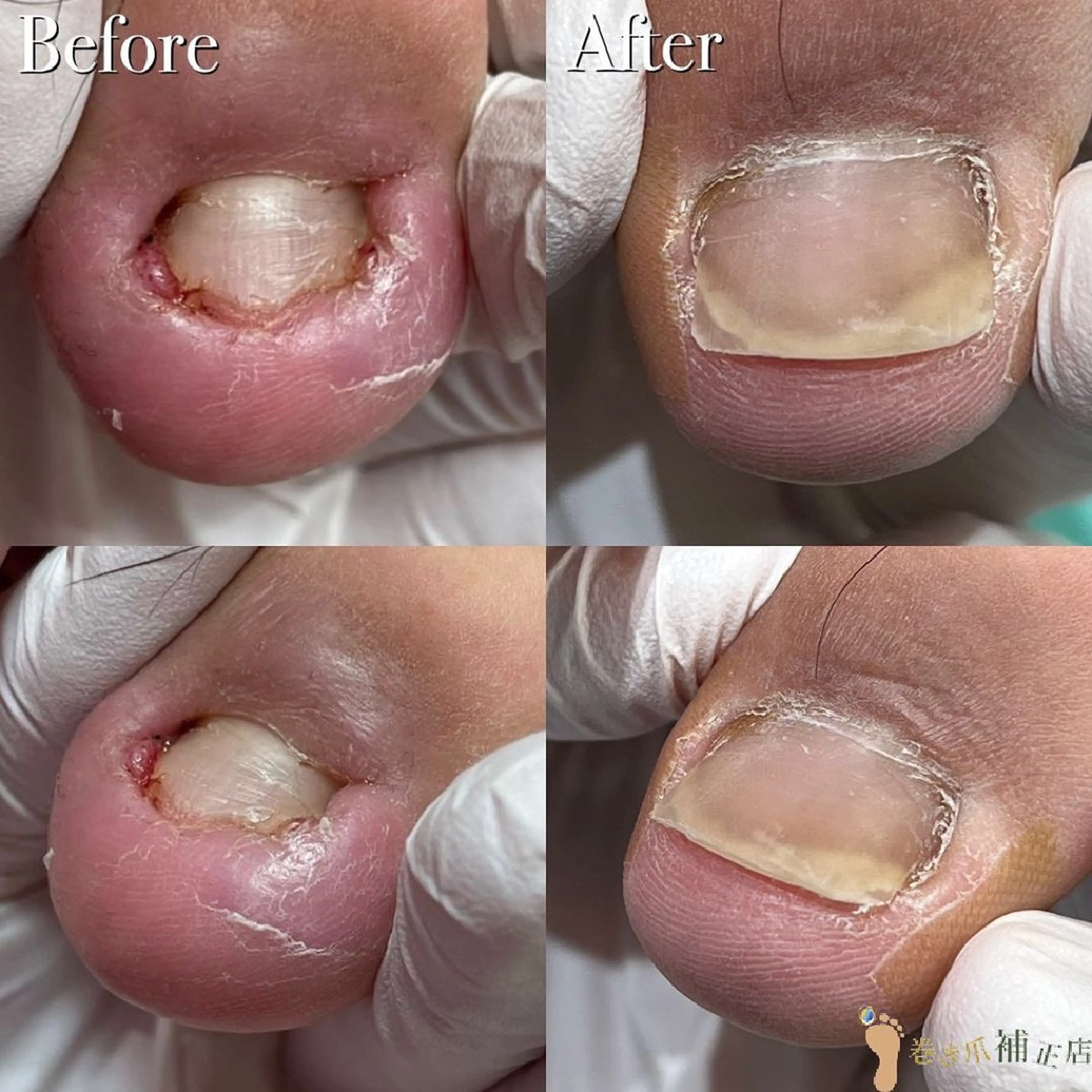 ネイル 巻き爪補正店越谷店所属・巻き爪補正店 越谷店のネイルデザイン