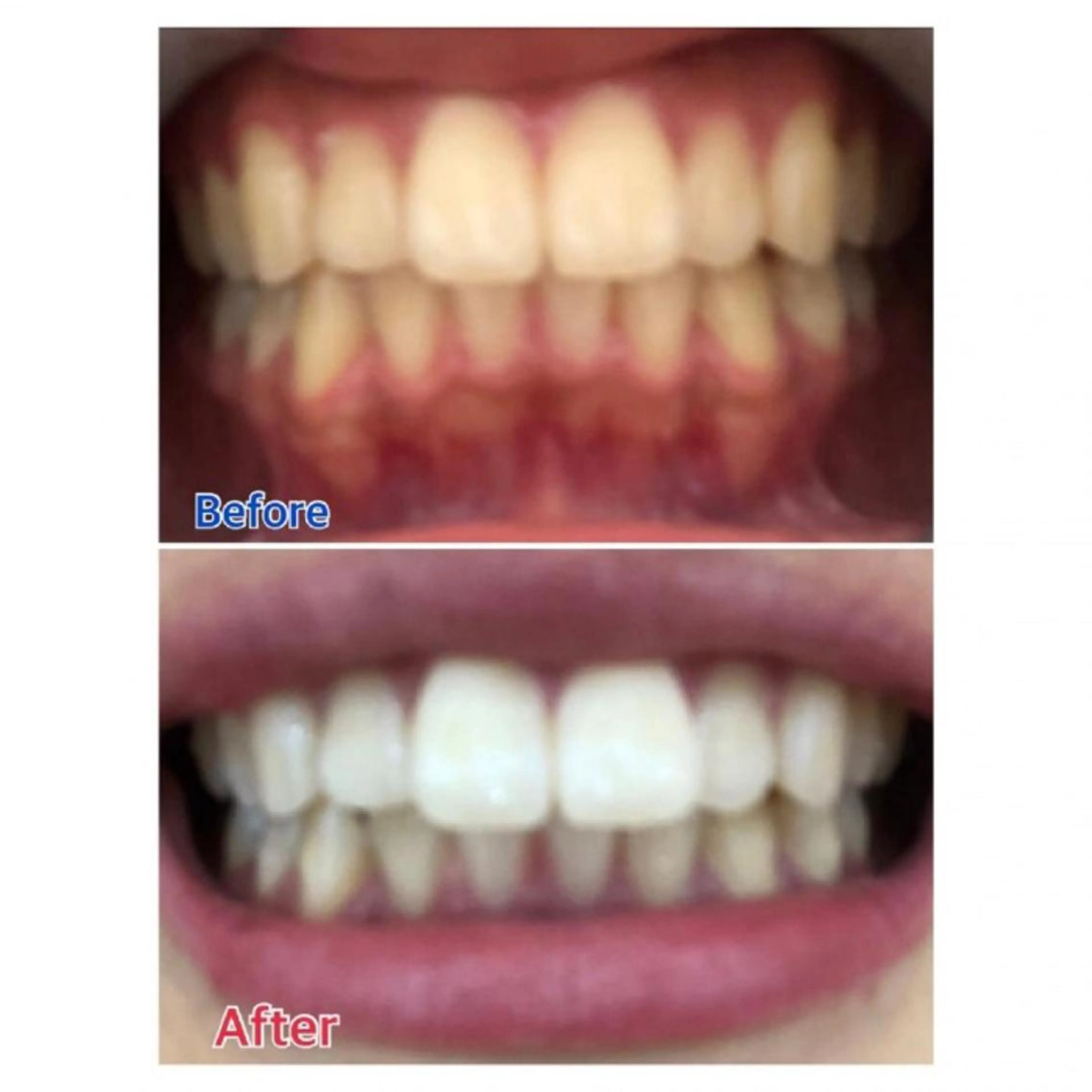 ☆学割☆1回でわかるホワイトニング体験♪1回分🌷！の写真