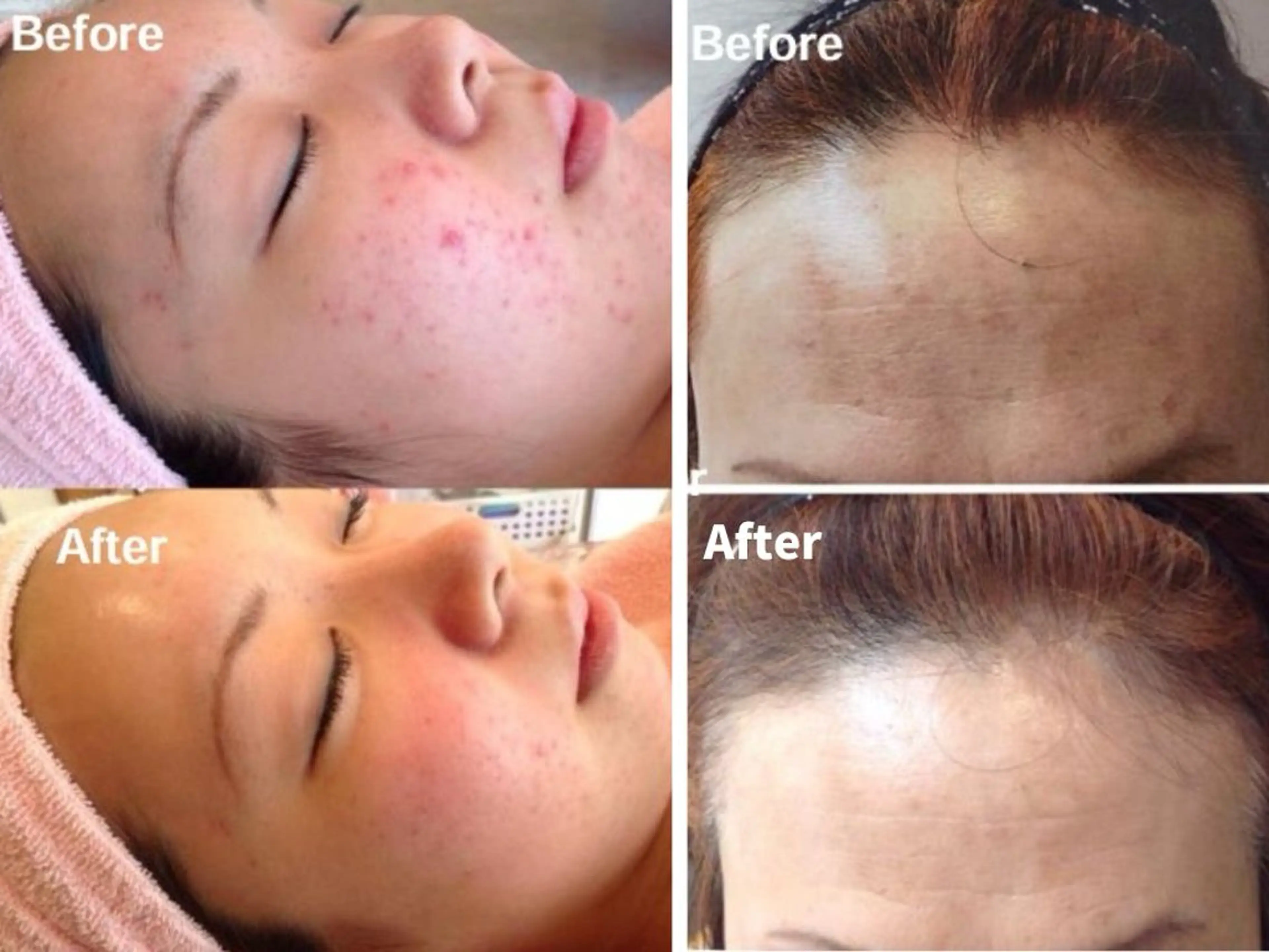 ハーブピーリング　剥離なしの写真