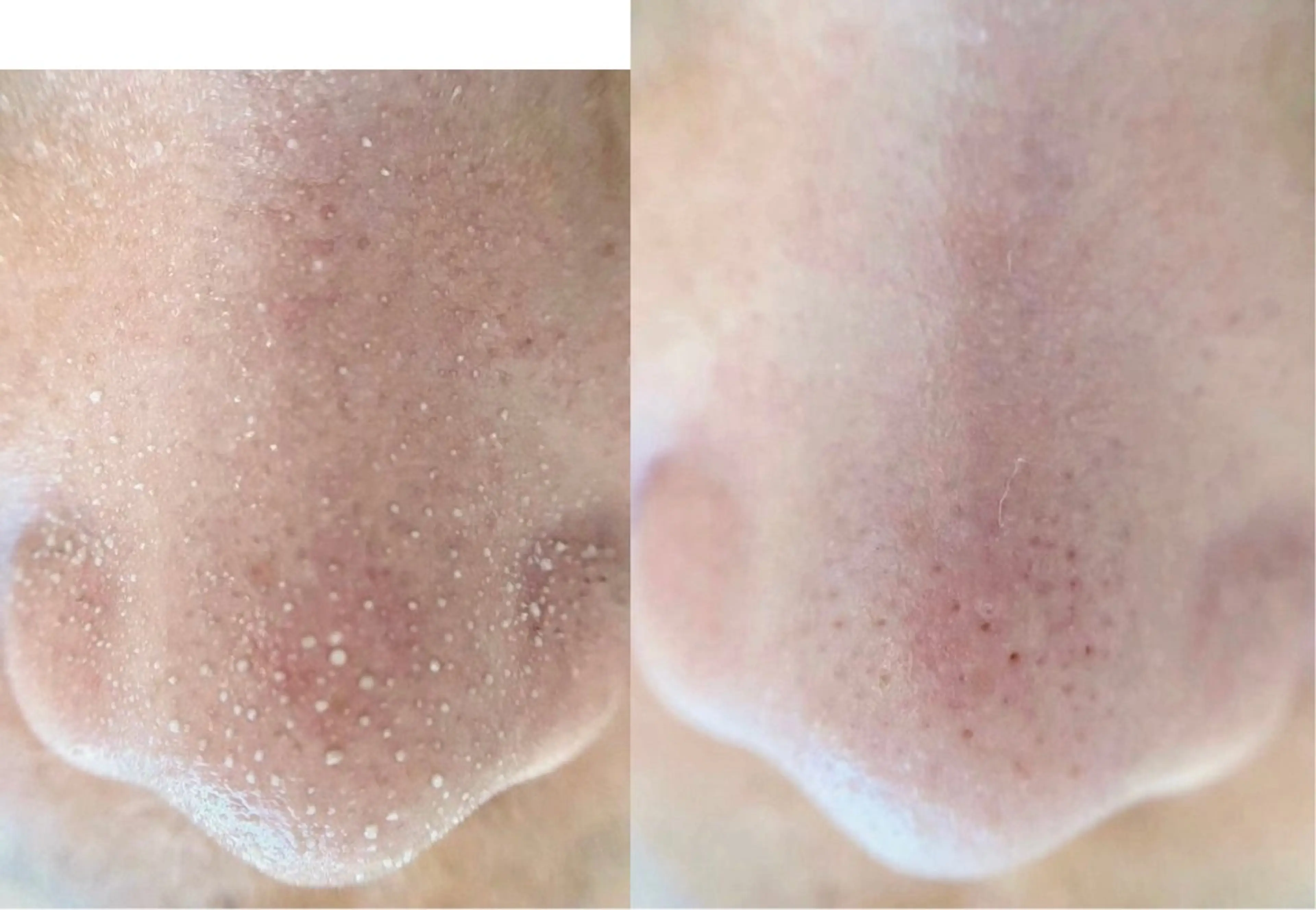 【2ヶ月以内再来◆極上たまご肌】韓国式3D毛穴洗浄 ¥15400→¥13400の写真