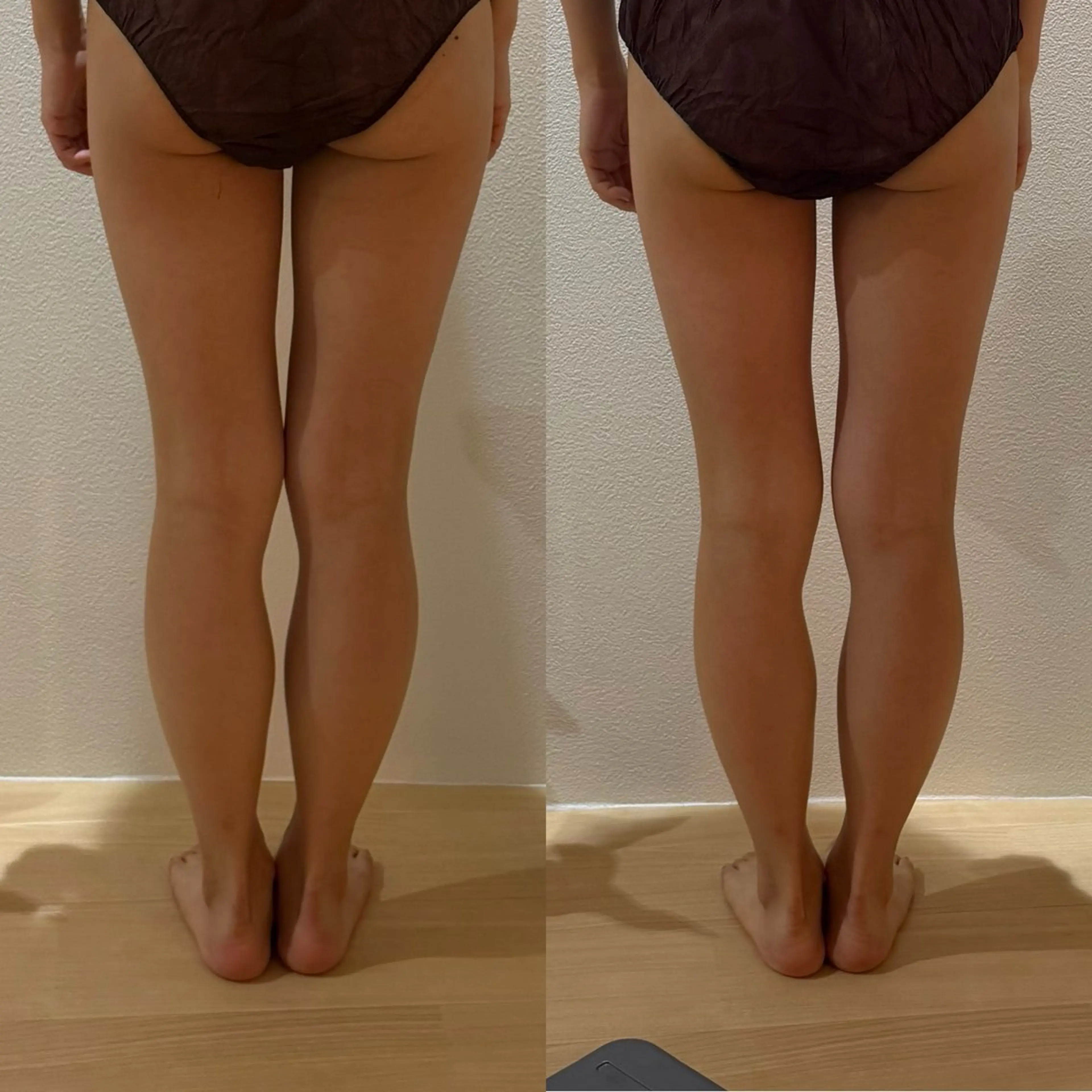 【✨ダイエット効果抜群✨】キャビテーション＆ラジオ波＆バキューム60分コースの写真