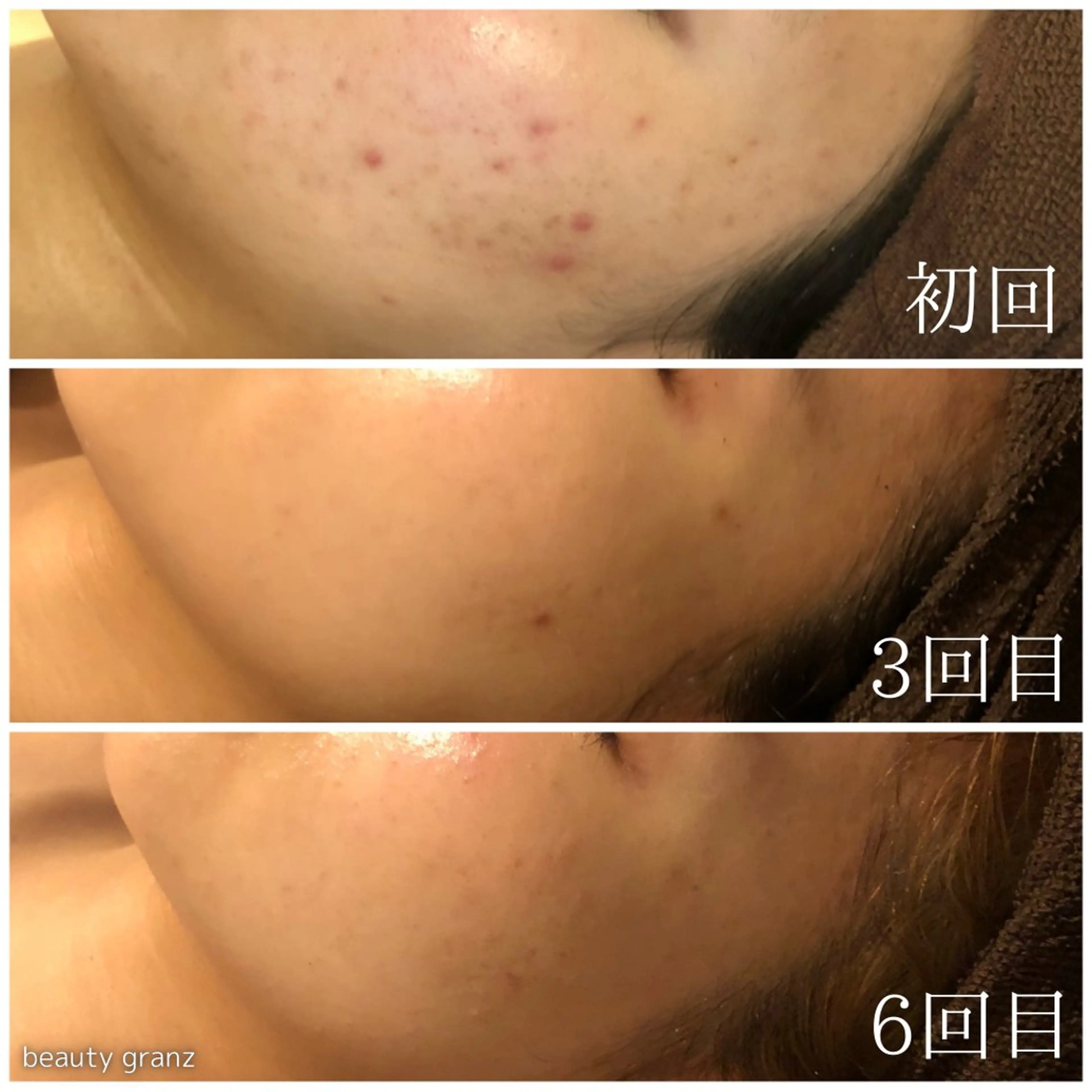 エステ 毛穴ニキビ専門 ビューティーグランツのエステ・リラクイメージ