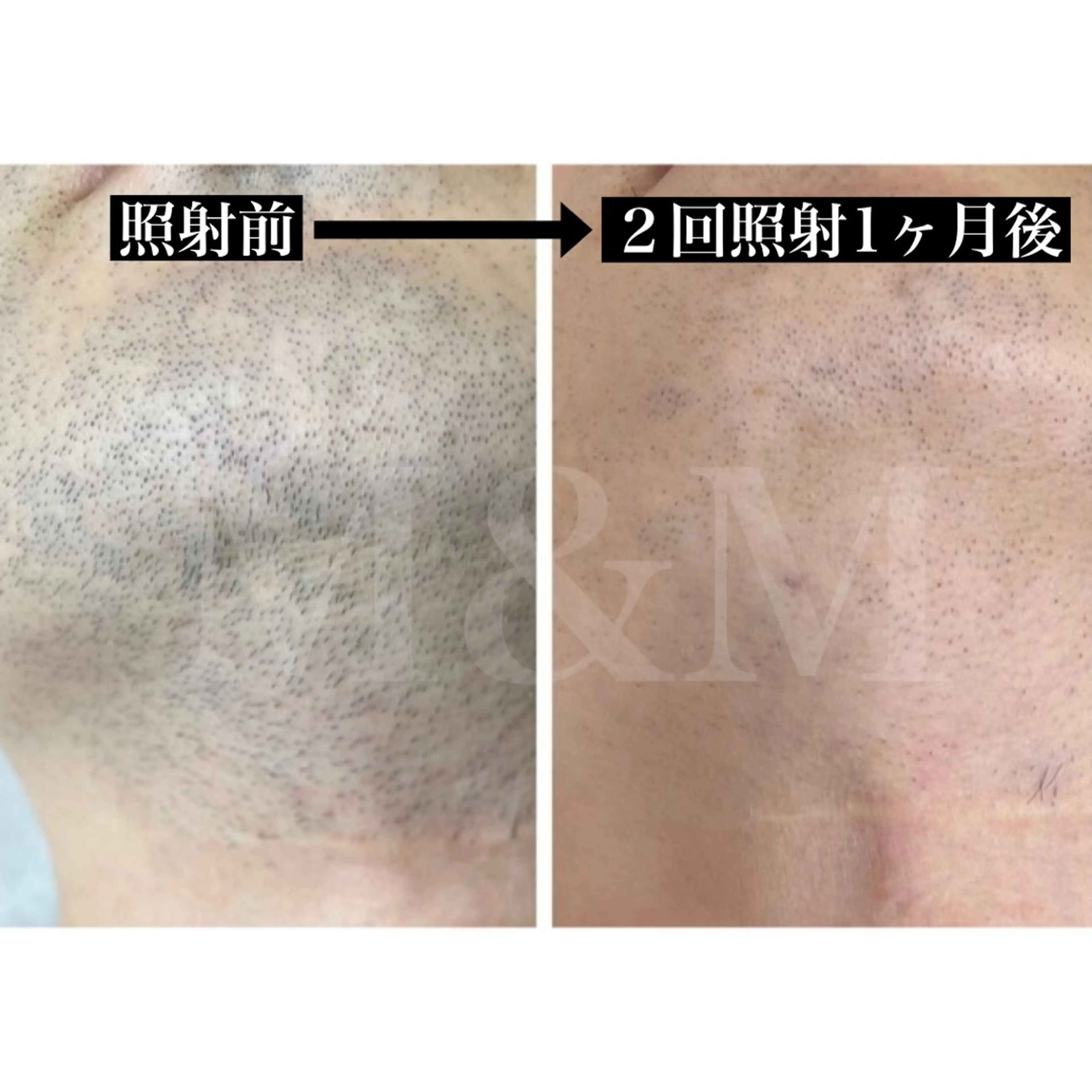 脱毛 大野 満広のエステ・リラクイメージ