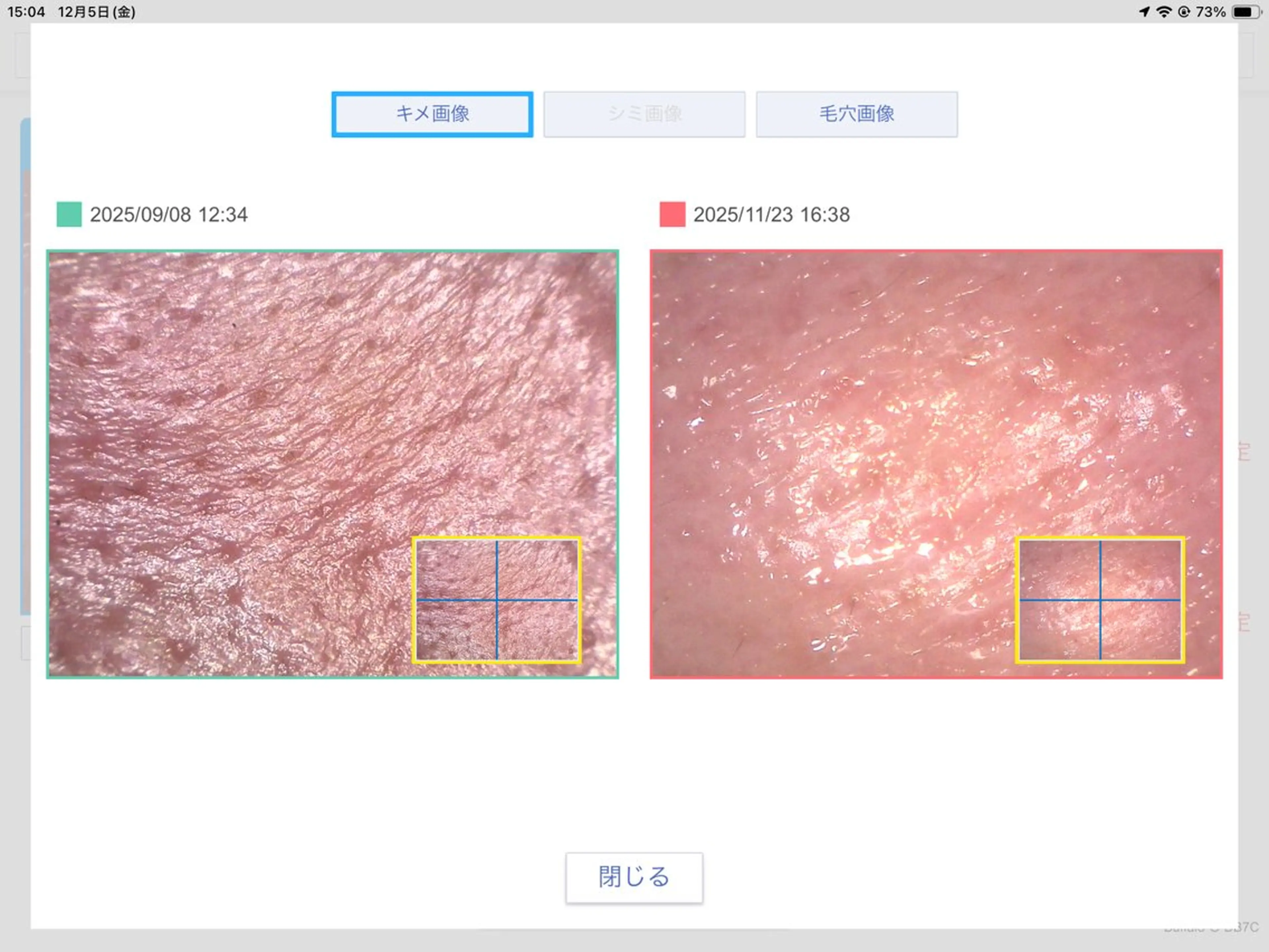 【🎓学割】オーダーメイド毛穴洗浄￥18700→4500 (黒ずみ・ニキビ・乾燥・汚れなど)の写真