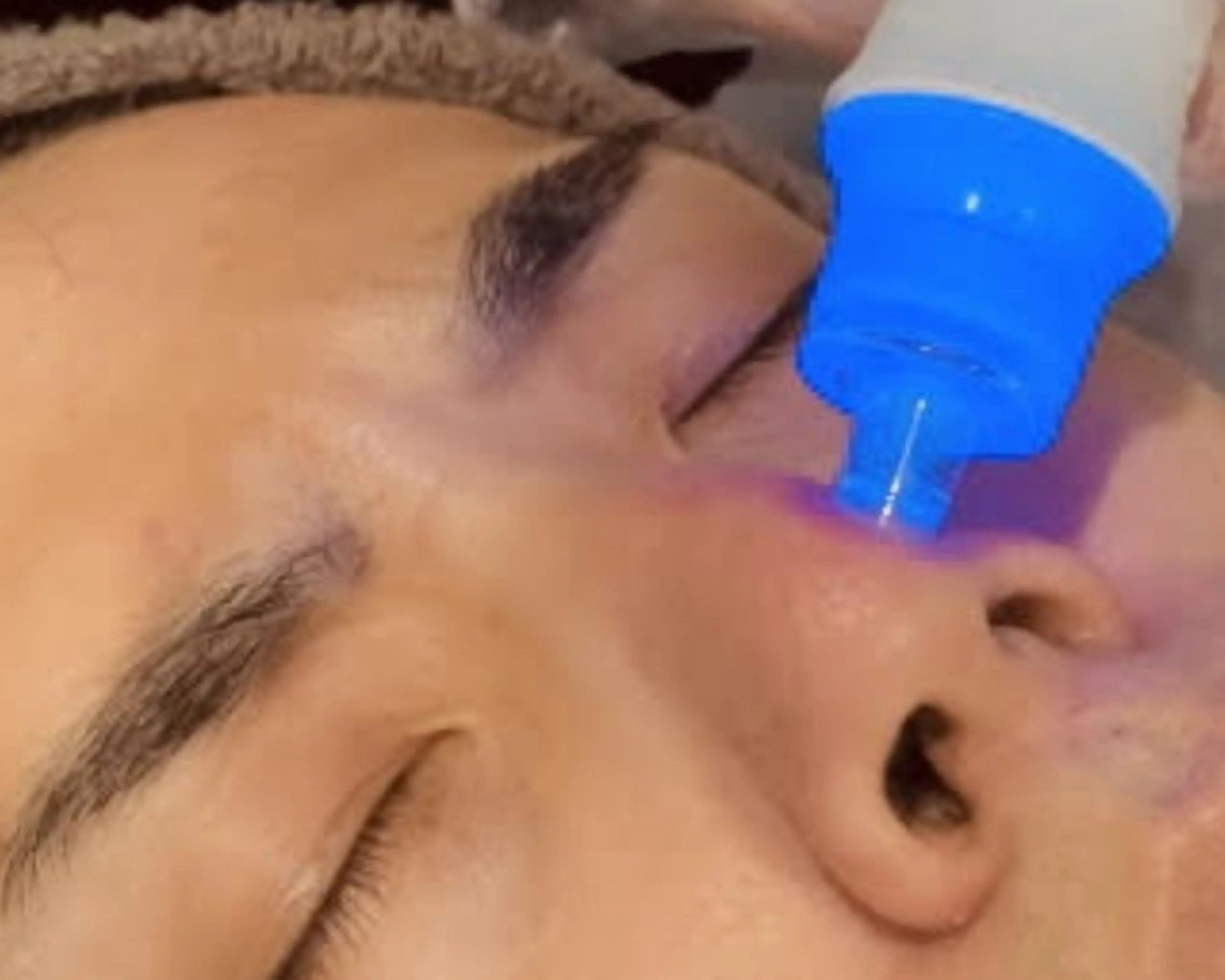 ハイドラフェイシャル　通常コース（毛穴洗浄含）の写真