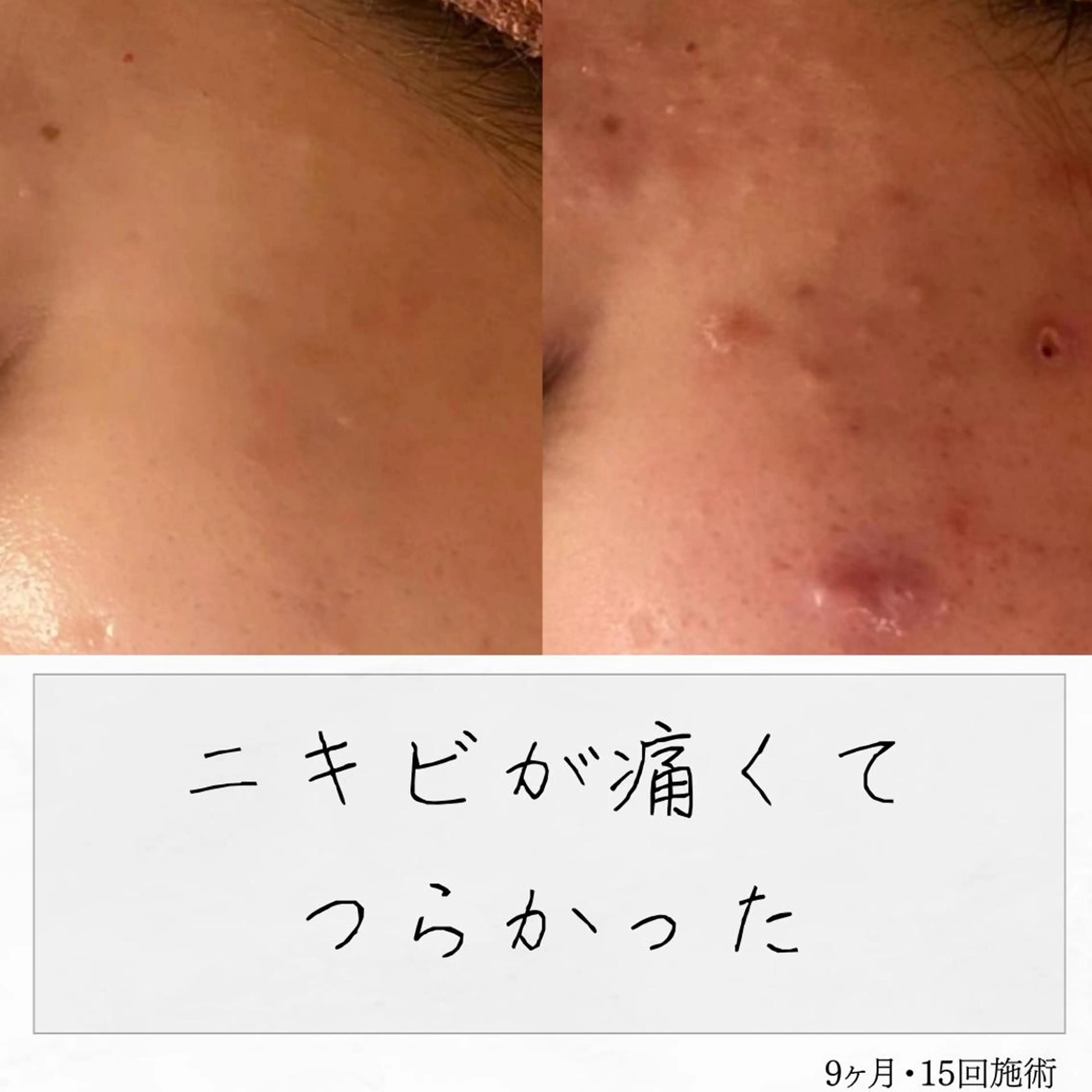 ニキビ経験者が施術 する専門サロン🌻のエステ・リラクイメージ