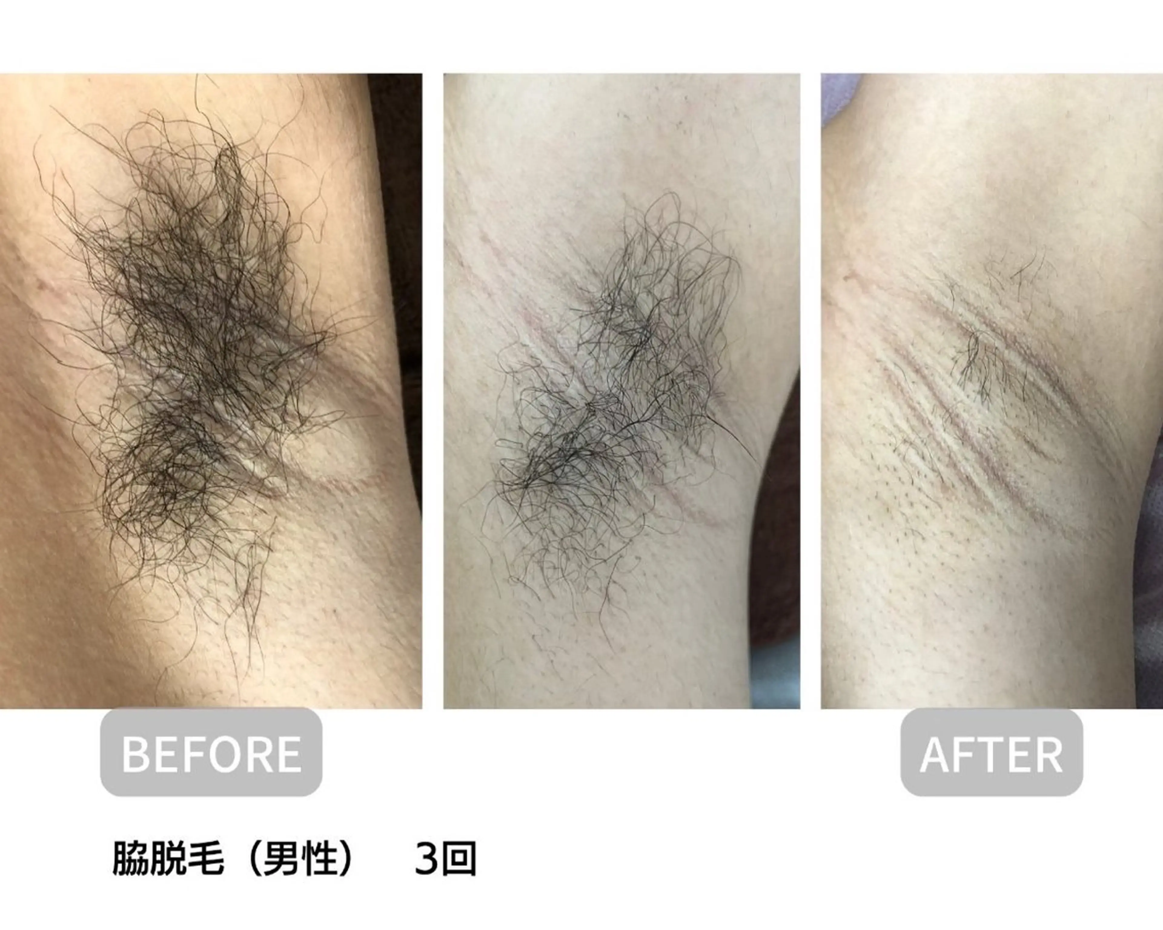 （特別価格50％割引)両ワキ脱毛6回🌸 脱毛初心の方にオススメ  🌸減毛と同時に美白、毛穴引き締め、ツルすべ肌に🌸の写真