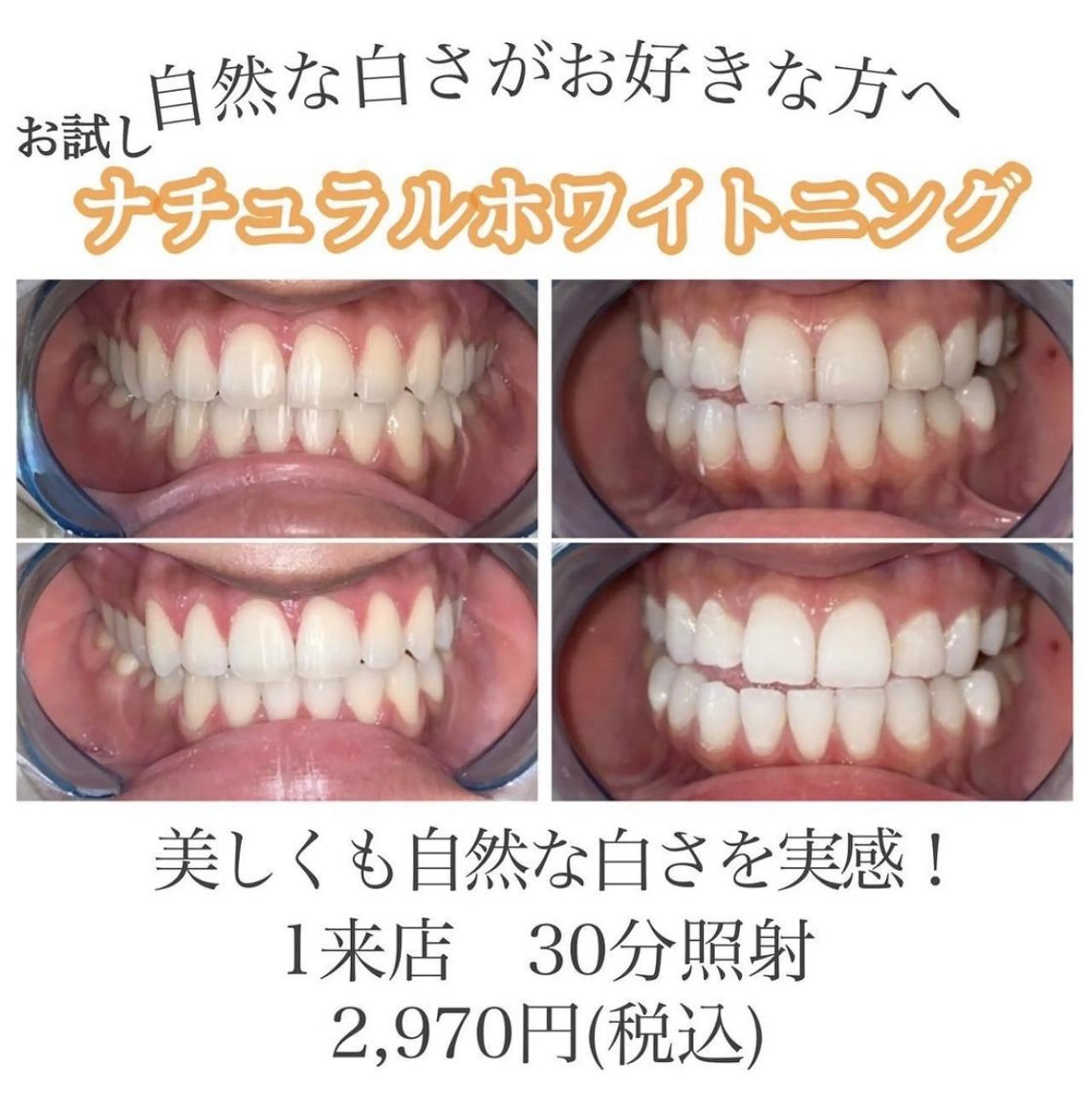 【初回体験✨】お試しセルフホワイトニング計30分照射 痛みなく自然な白さへの写真