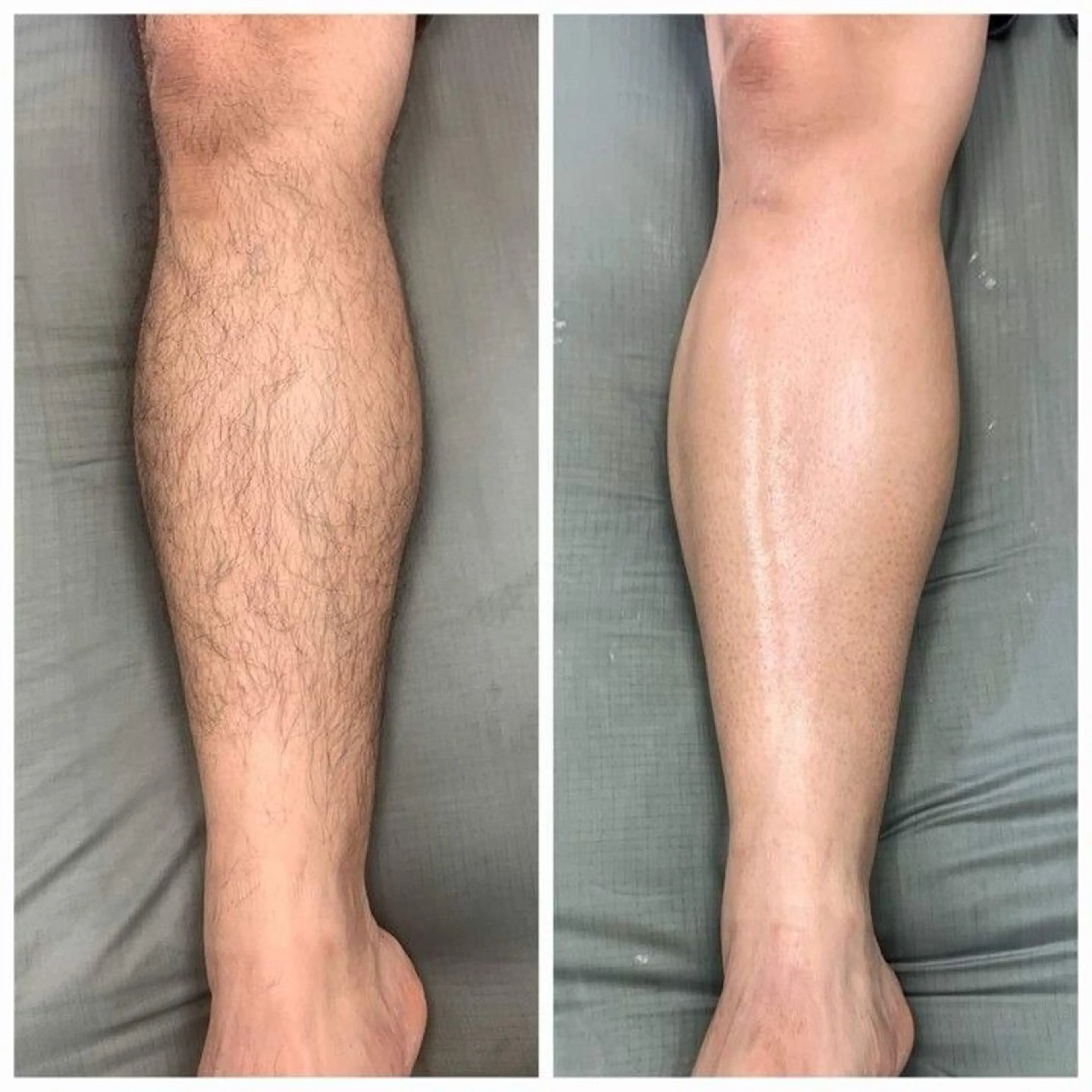 【メンズ人気】ヒゲ＋腕＋脚＋ワキ脱毛の写真