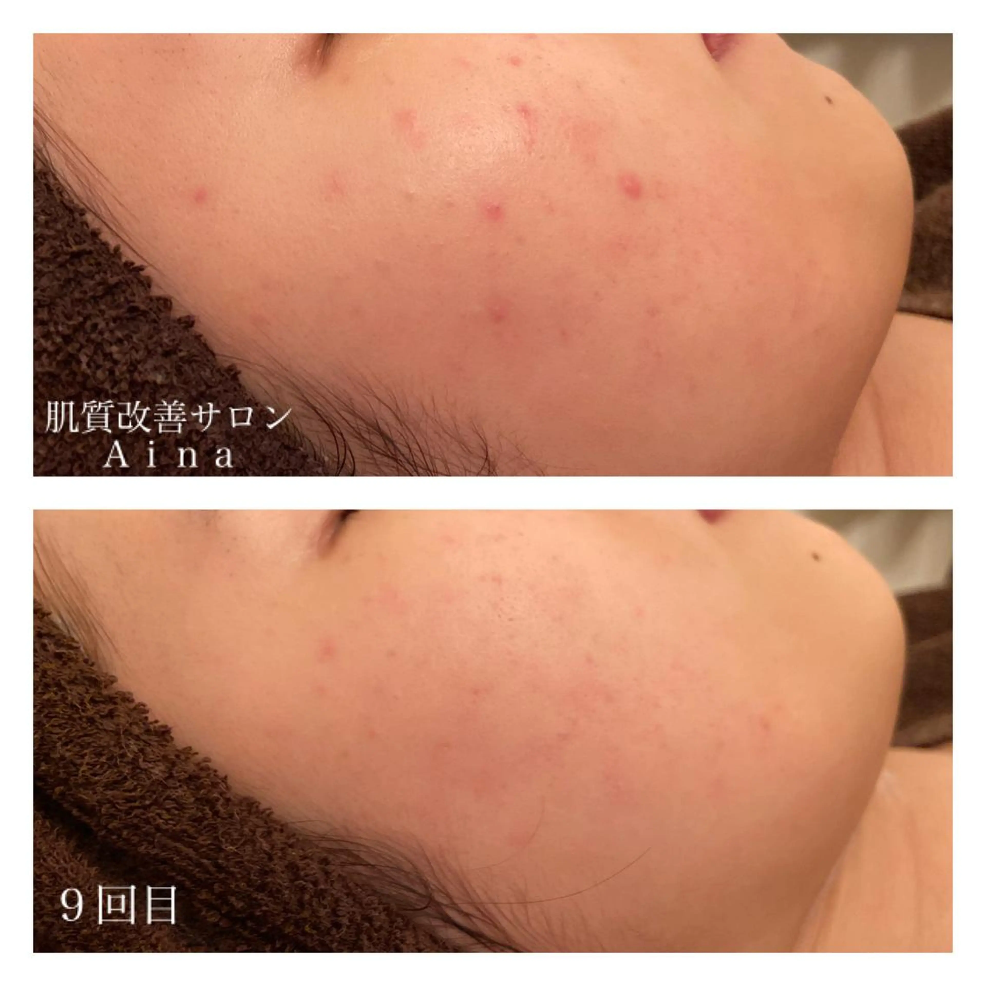 セミロング カラー パーマ ヘアアレンジ メンズ ネイル マツエク・マツパ エステ リラク ニキビ跡専門サロン Ａｉｎａのエステ・リラクイメージ