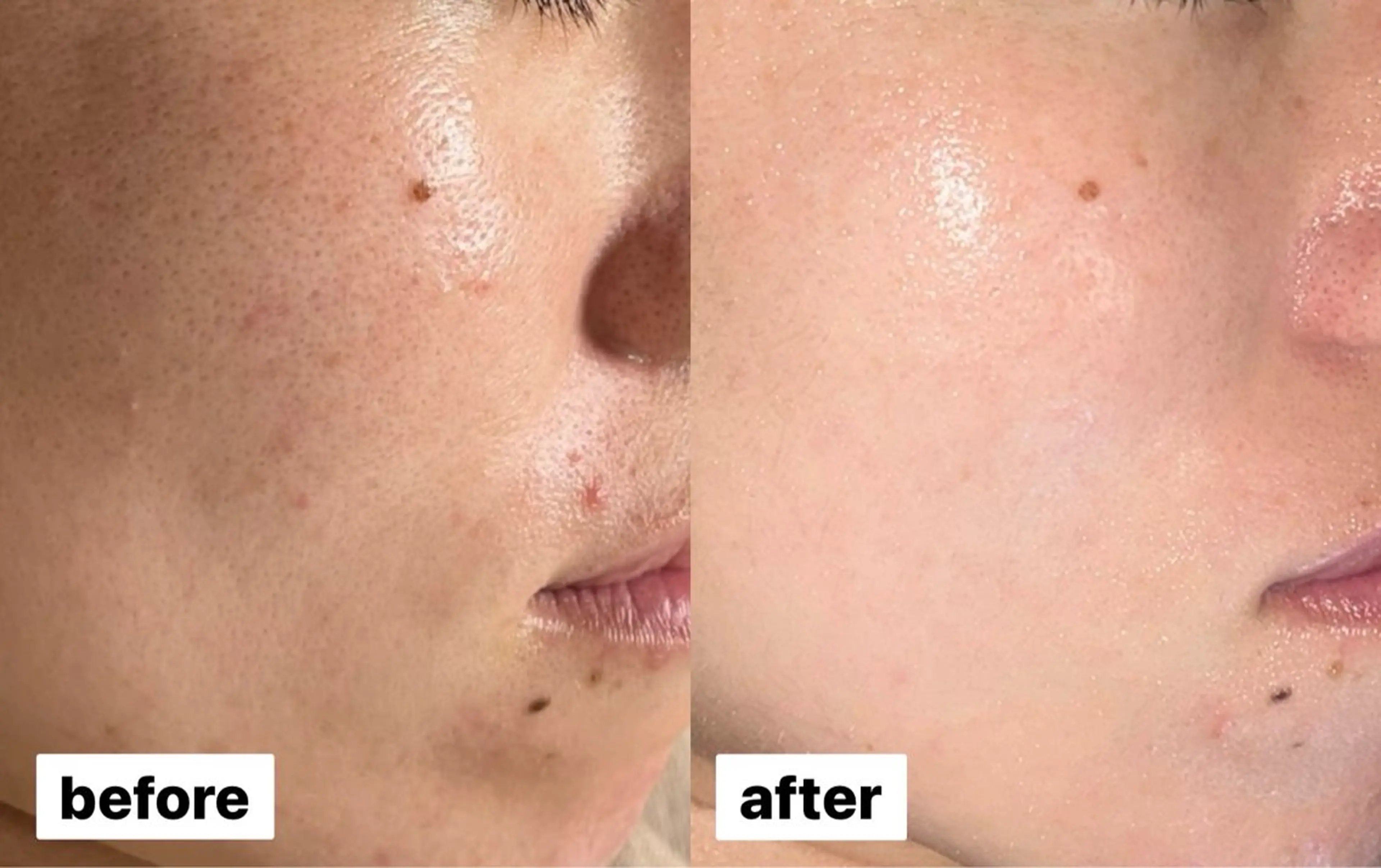 エステ 【ニキビ肌改善】 肌質改善Ohanaのエステ・リラクイメージ