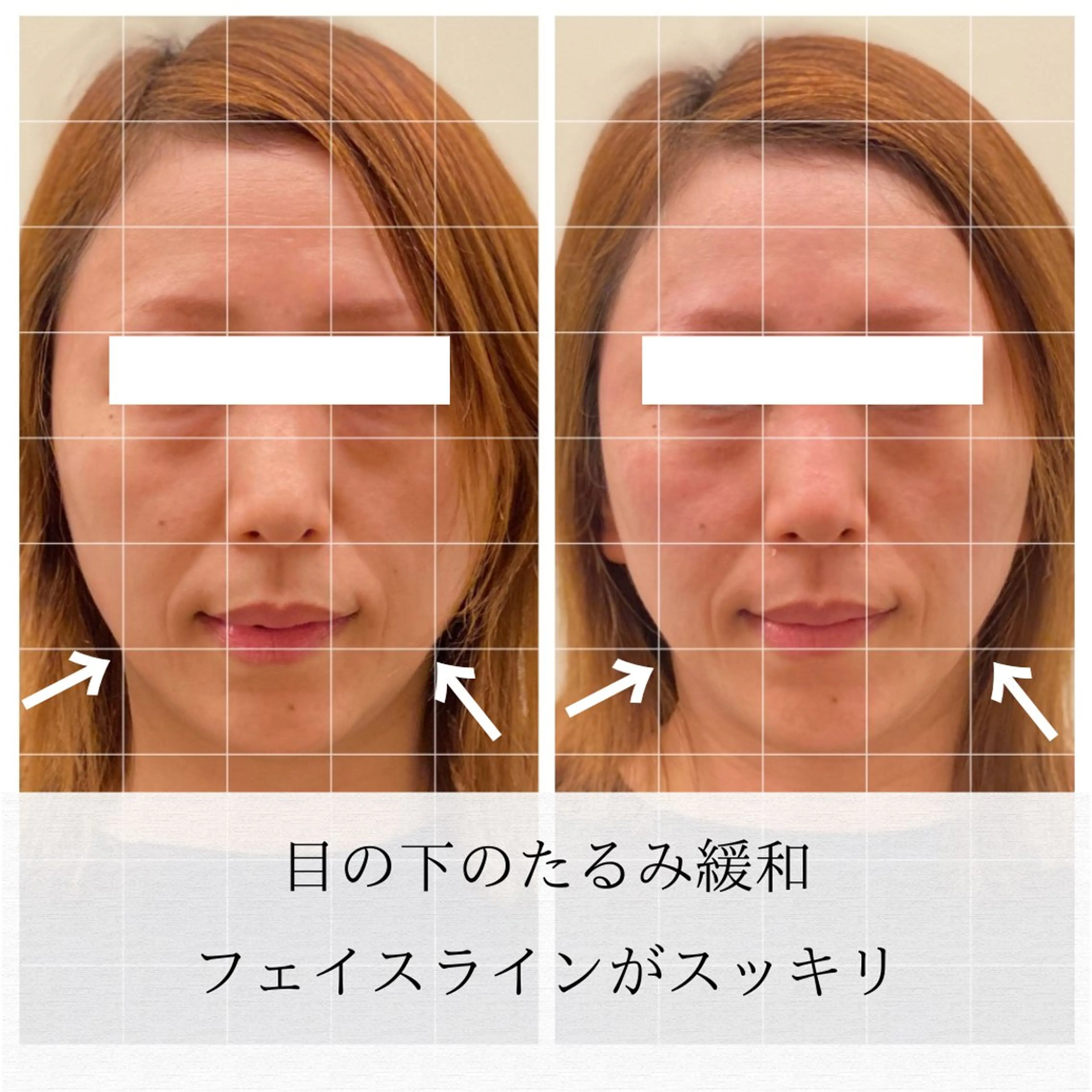 美容鍼/ヘッドスパ/ 💎さかもとのエステ・リラクイメージ