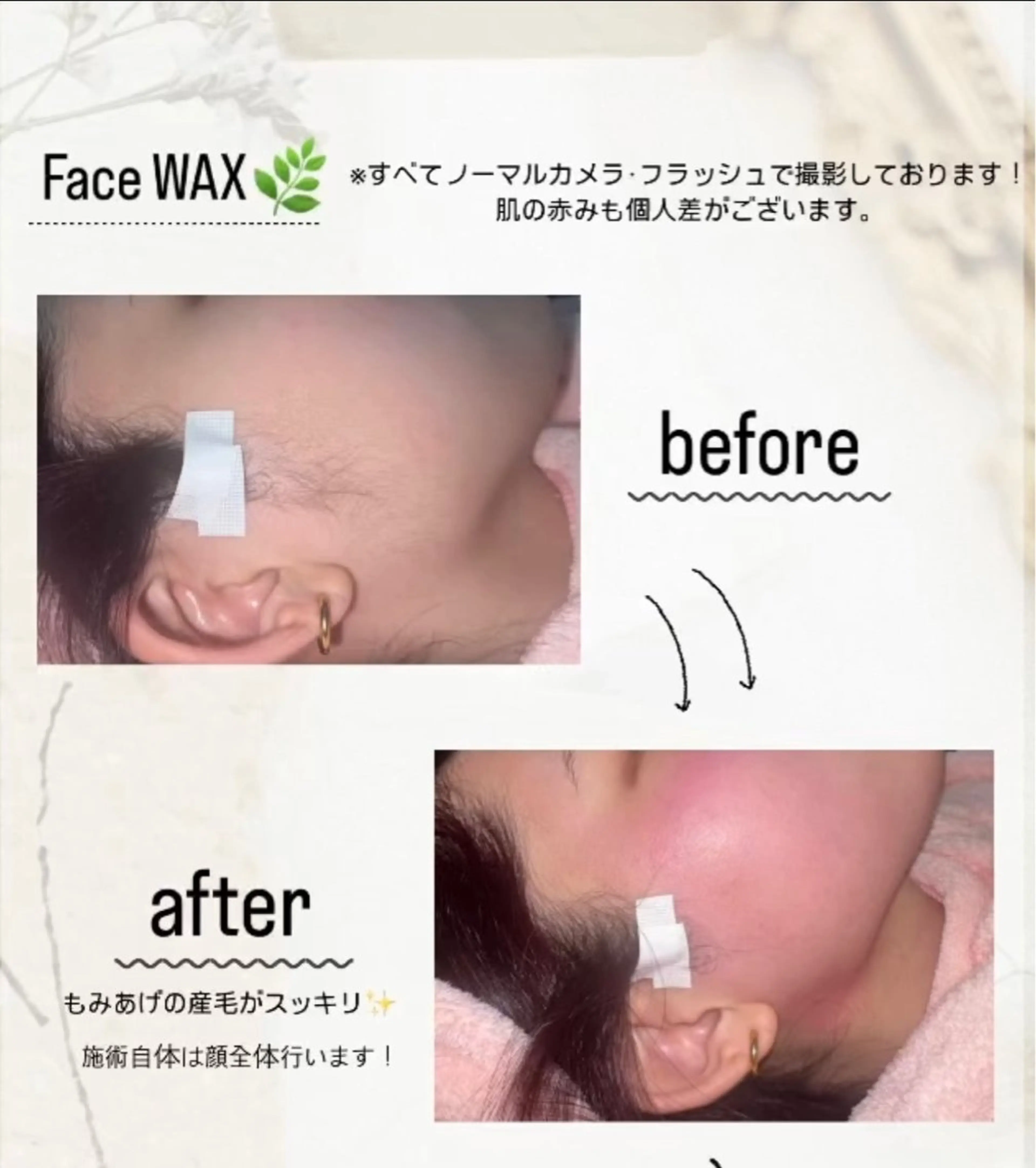 Face wax 脱毛(フェイスワックス) お顔全体のワックス脱毛です🌿 保湿ケア込✨の写真