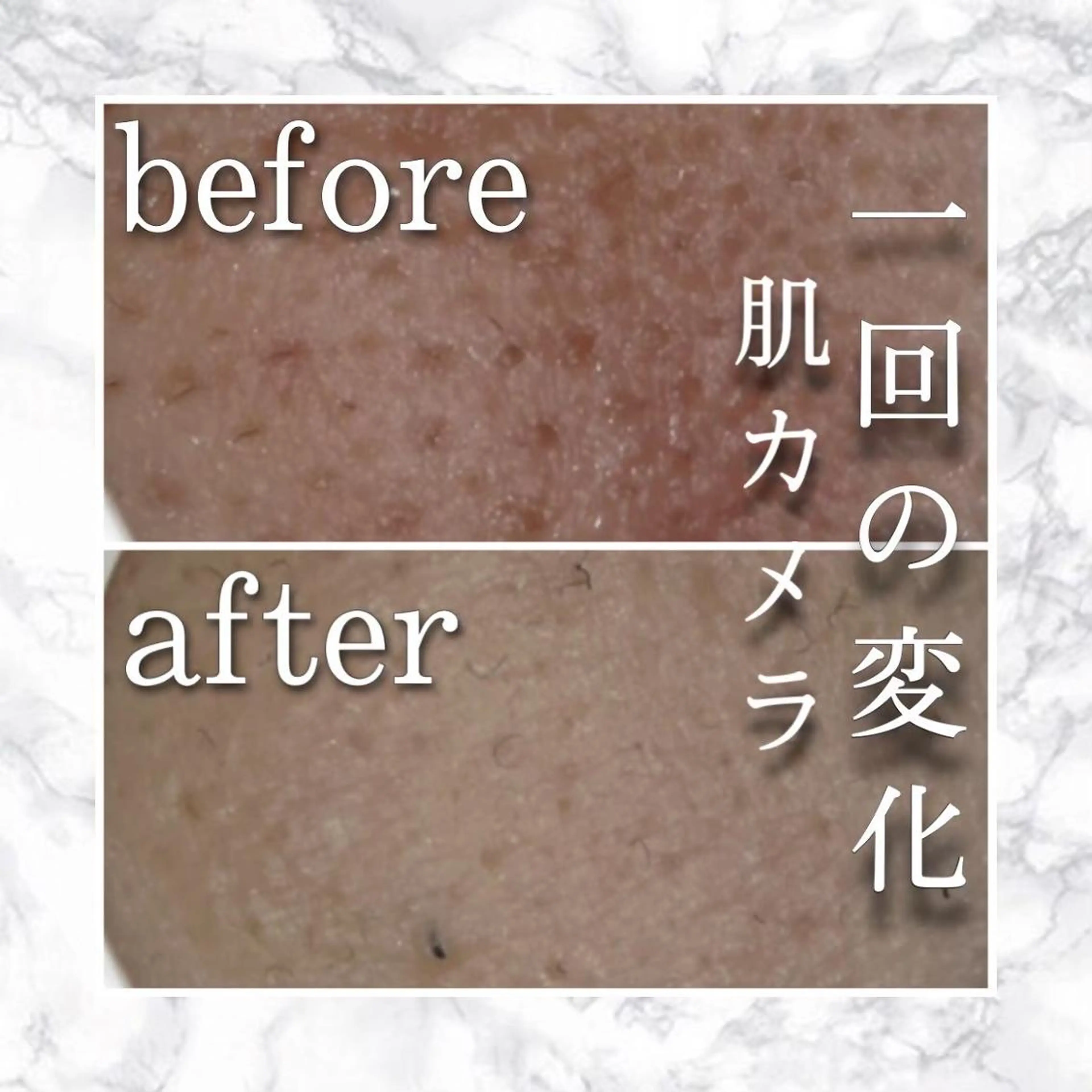 ニキビ跡改善専門🔥 医療にはできない改善のエステ・リラクイメージ