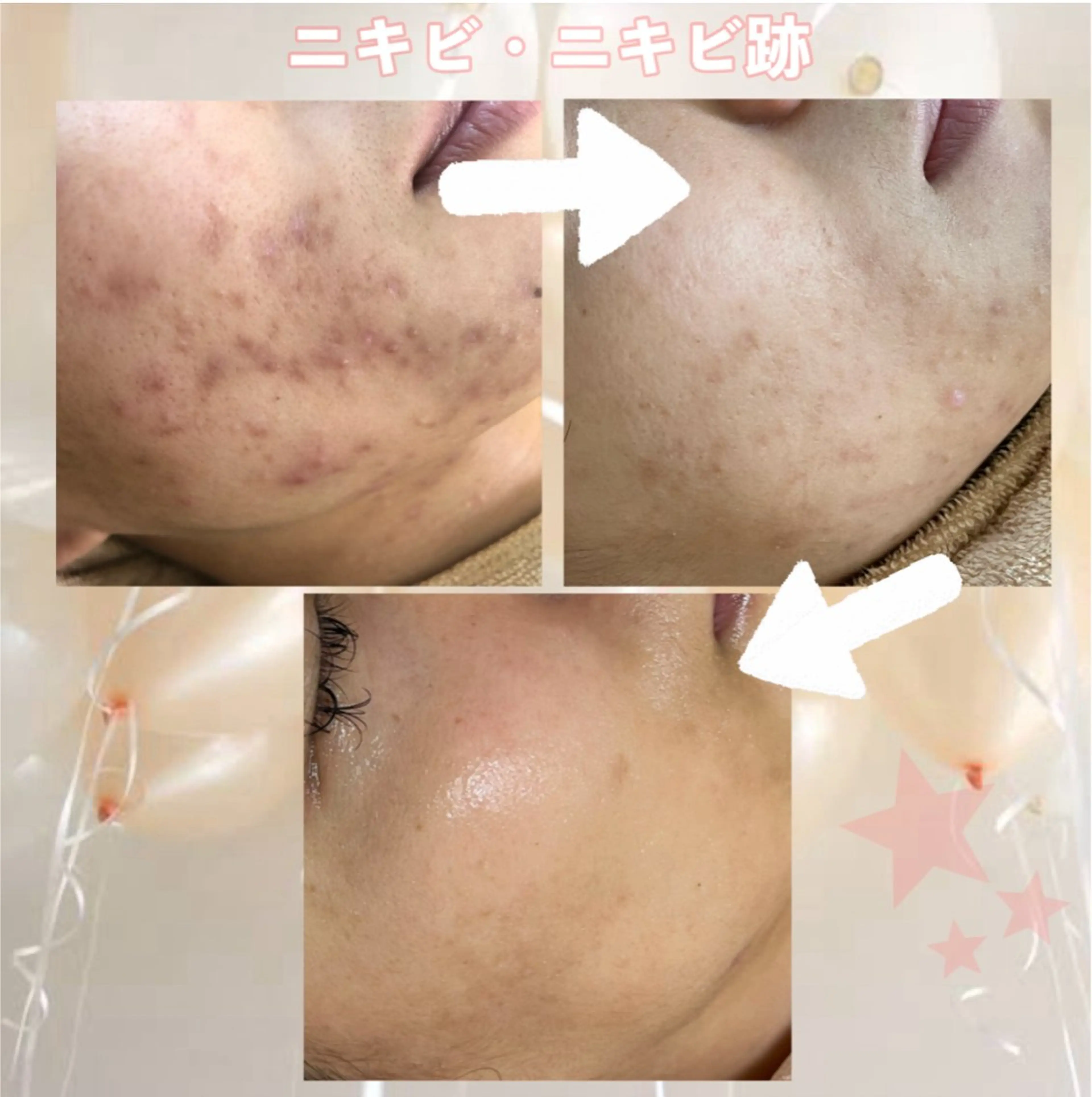 エステ ニキビ&跡改善サロン オーナー光木のエステ・リラクイメージ